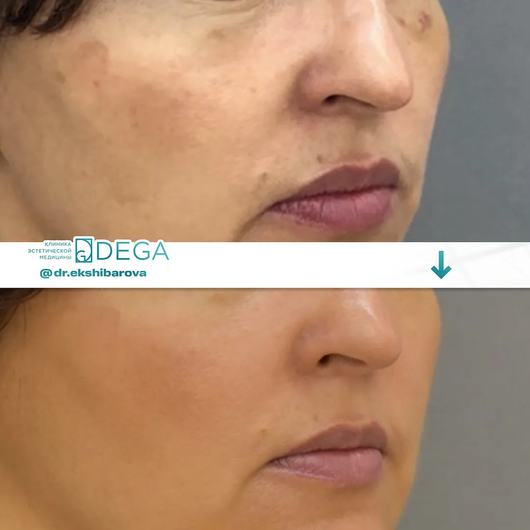 Екшибарова НИ - RF-лифтинг №51