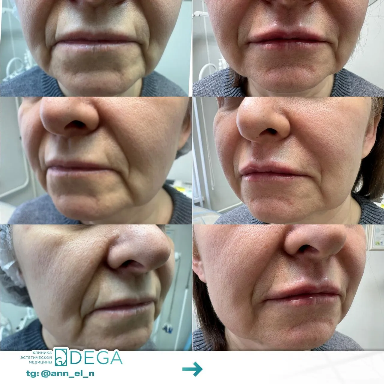 Дулмаева А.О. - Контурная пластика губ №11