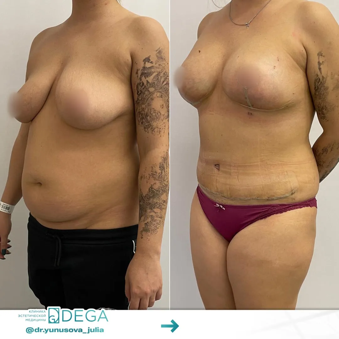 Юнусова ЮР - Абдоминопластика, Мастопексия №5