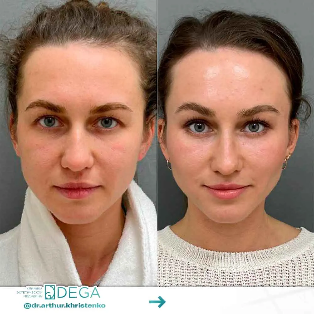 Христенко АА - Эндоскопическая периорбитопластика №3