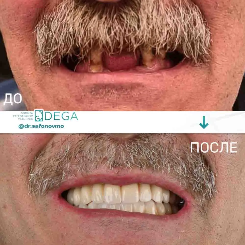 Сафонов МО - Виниры №1