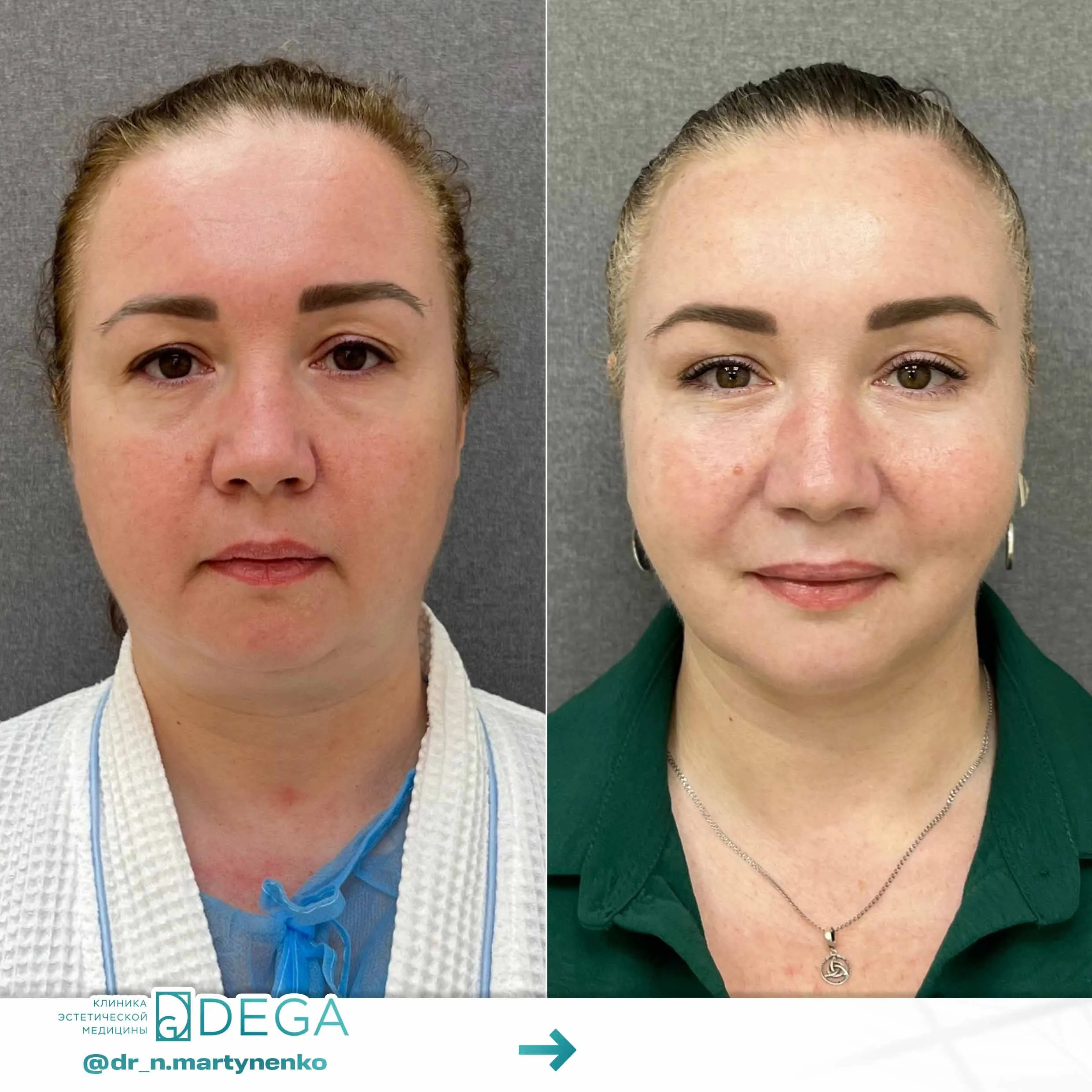 Мартыненко Н. А. — №6 Эндоскопическая подтяжка лица, Липосакция подбородка