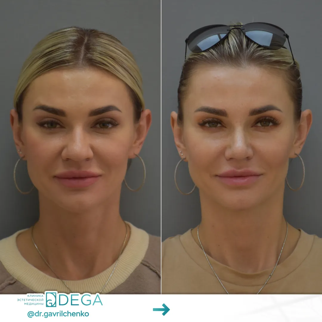 Гаврильченко АА - Ринопластика №28