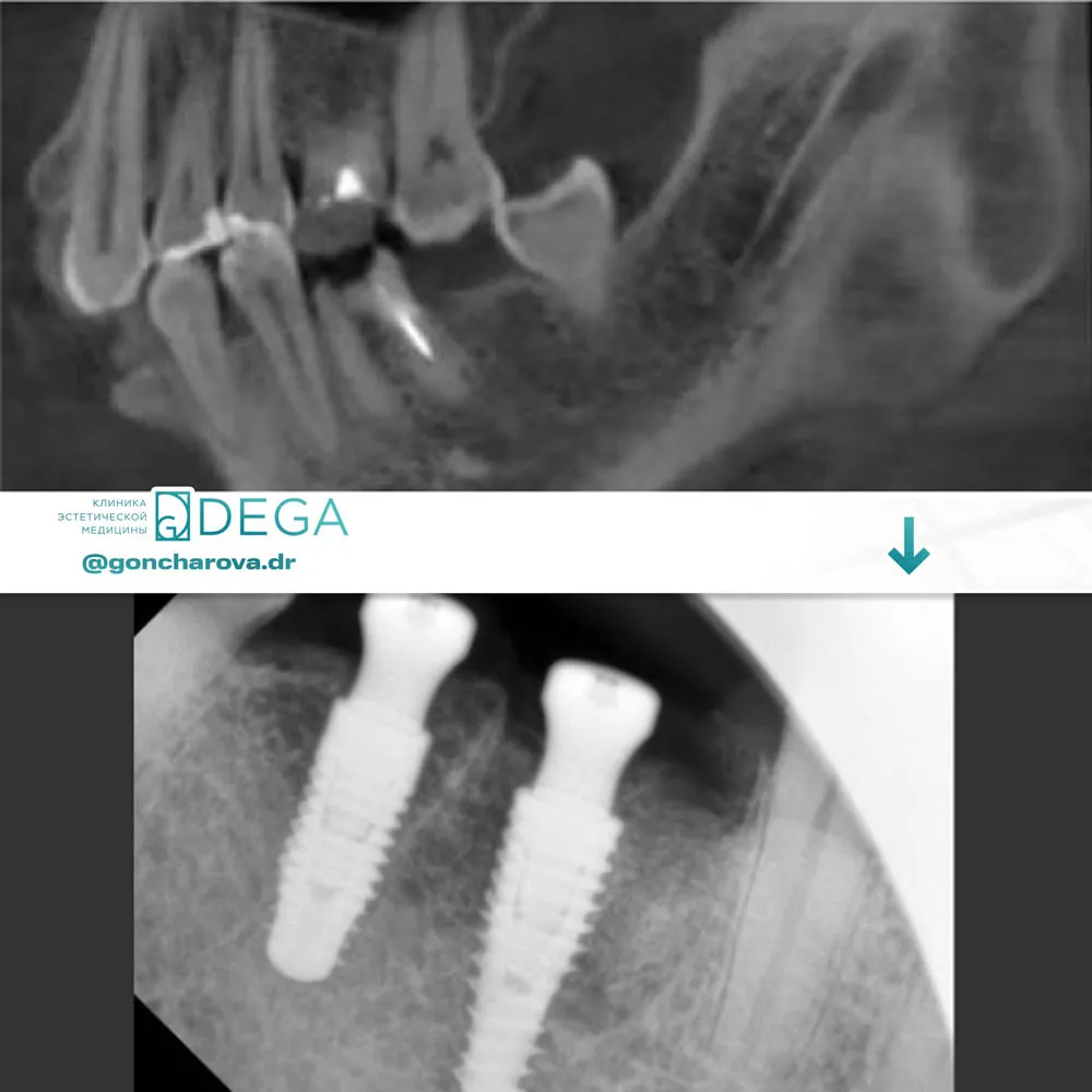 Гончарова ЮС - Имплантация №5