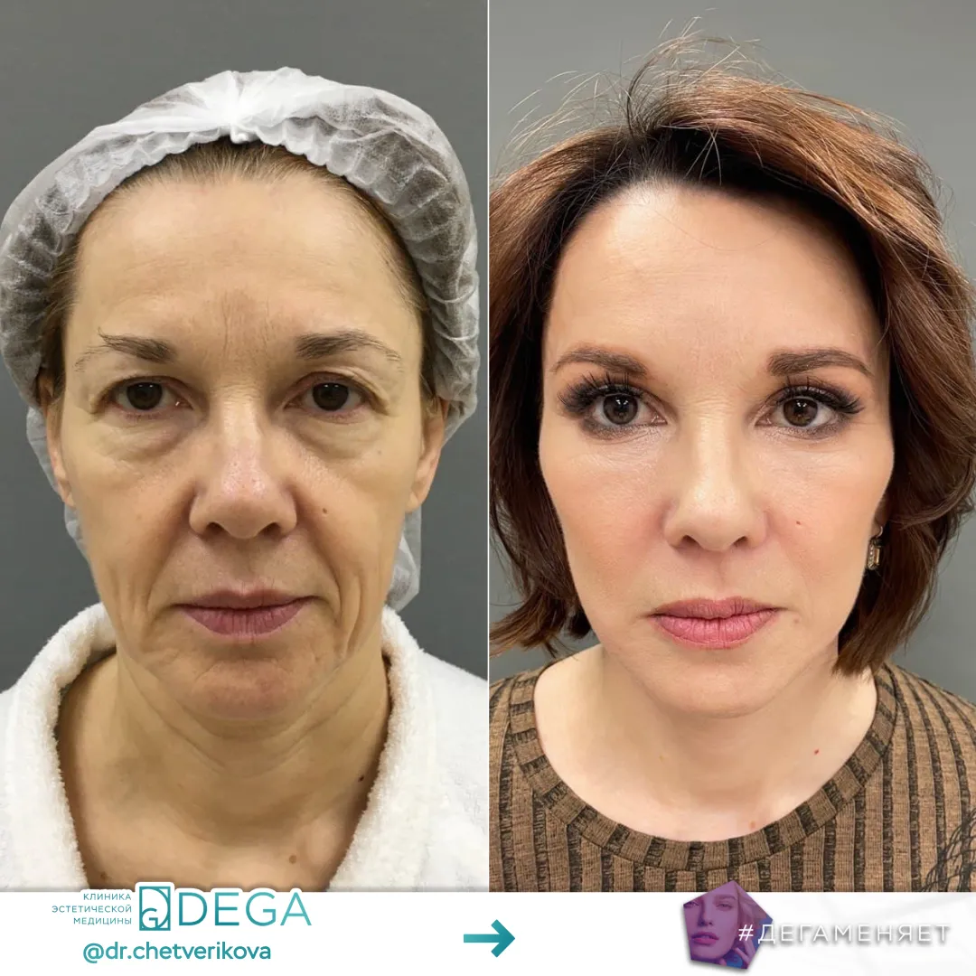 Четверикова МА - Эндоскопическая периорбитопластика, Платизмопластика, Фейслифтинг, Блефаропластика №16