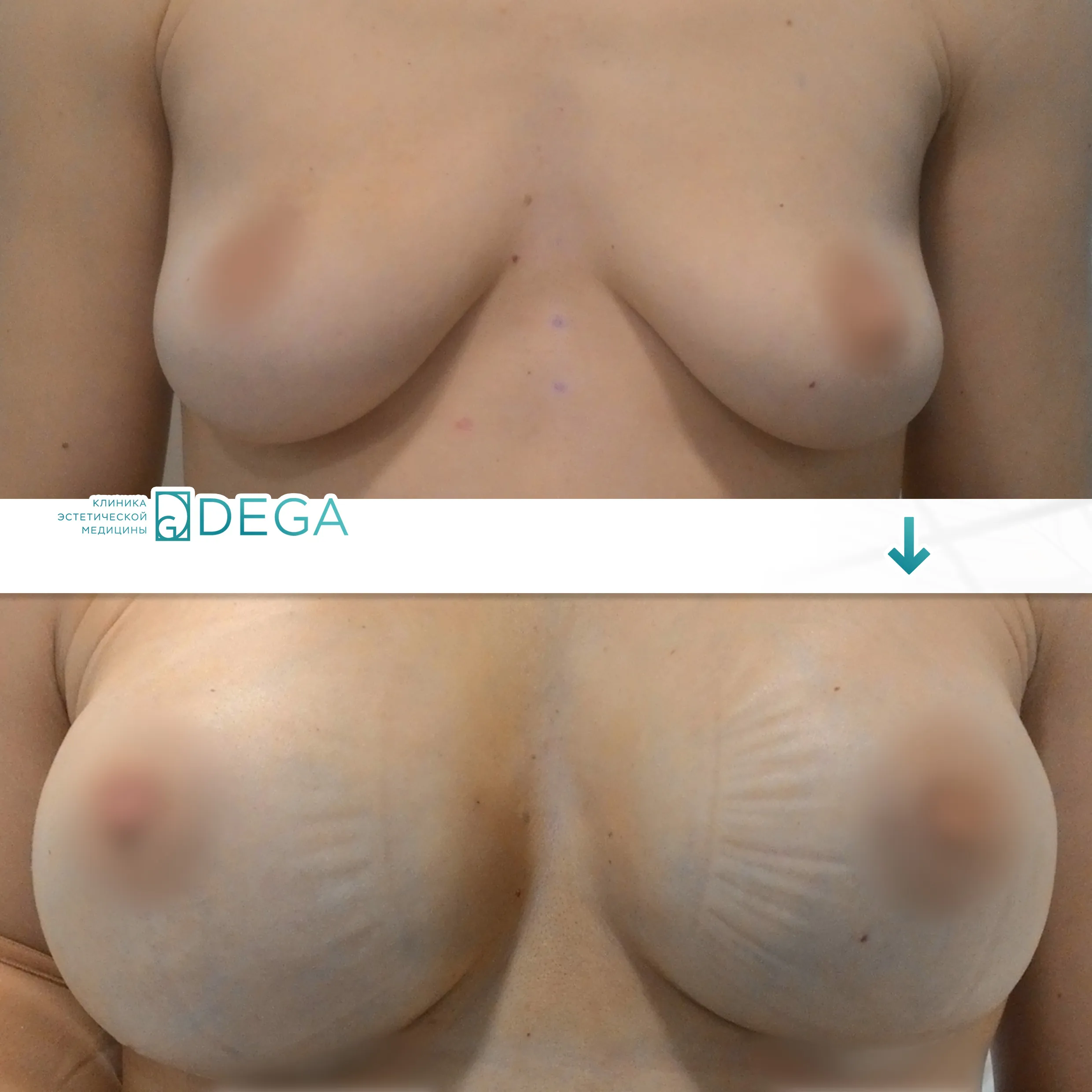 Шорников Евгений Сергеевич №1.1 Маммопластика Увеличение груди