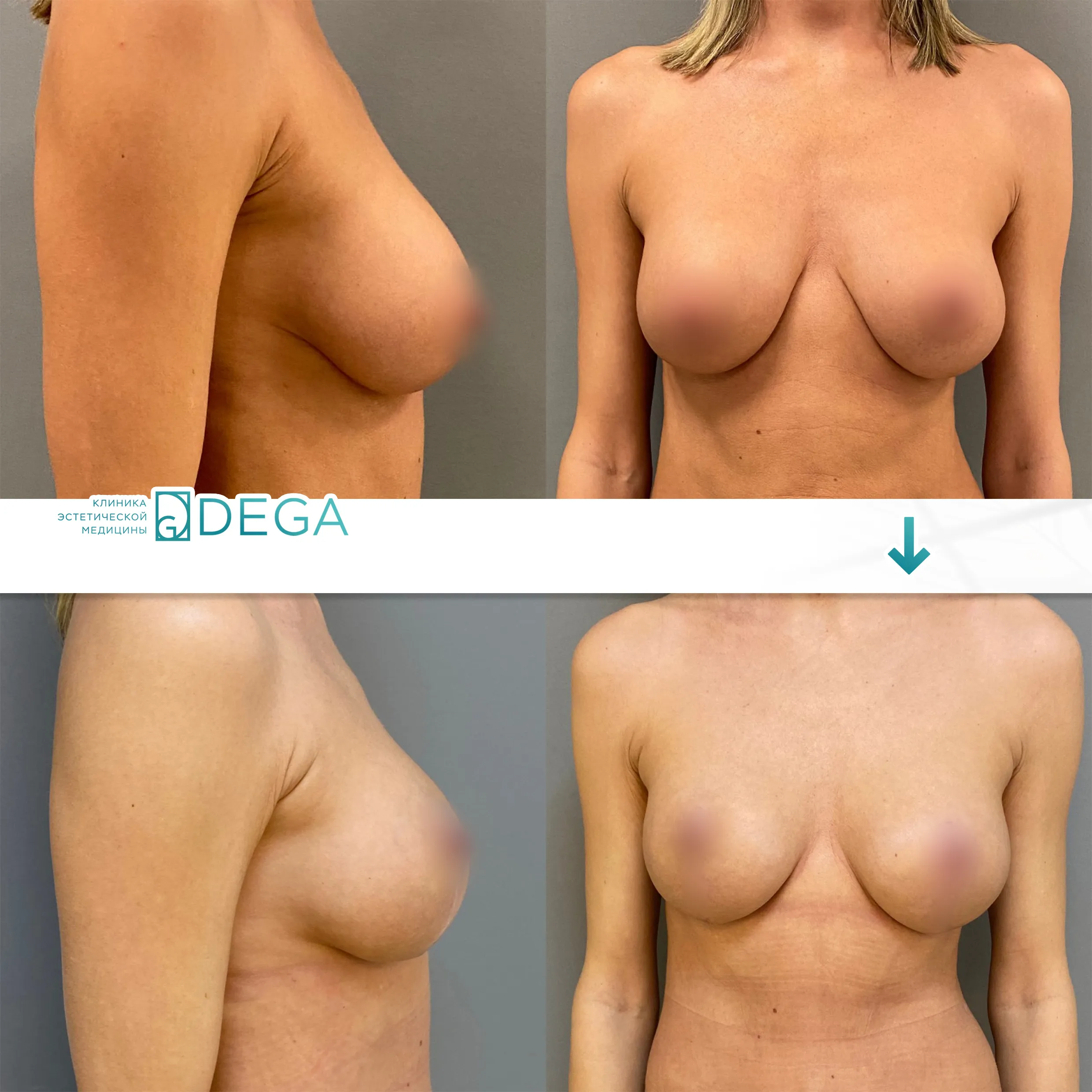Шорников Евгений Сергеевич №10 Маммопластика Увеличение груди Липофилинг груди