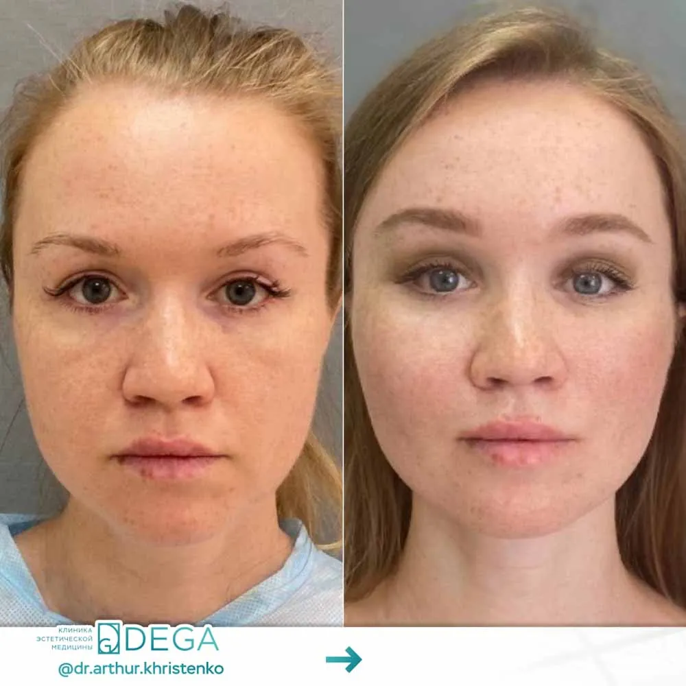 Христенко АА - Эндоскопическая периорбитопластика №7