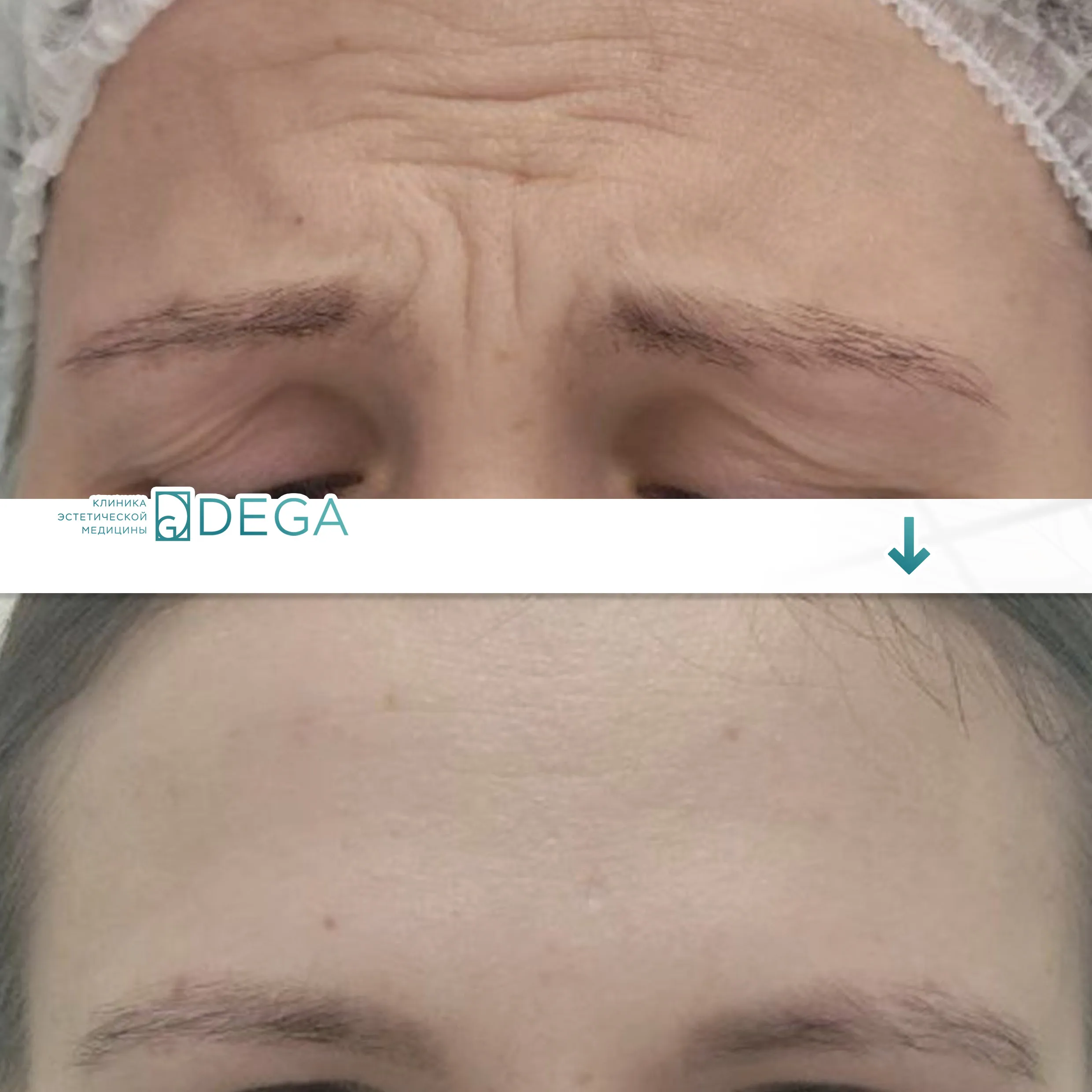 Бабичева С.Ю. — Ботулинотерапия №4