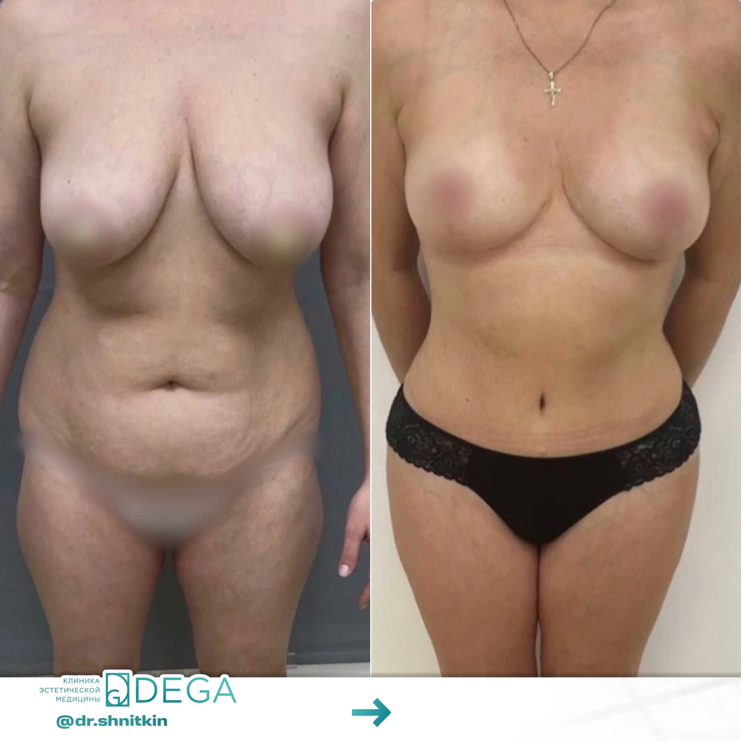 Шниткин Антон Сергеевич №11.1 Маммопластика Мастопексия (подтяжка груди) Абдоминопластика (пластика живота)