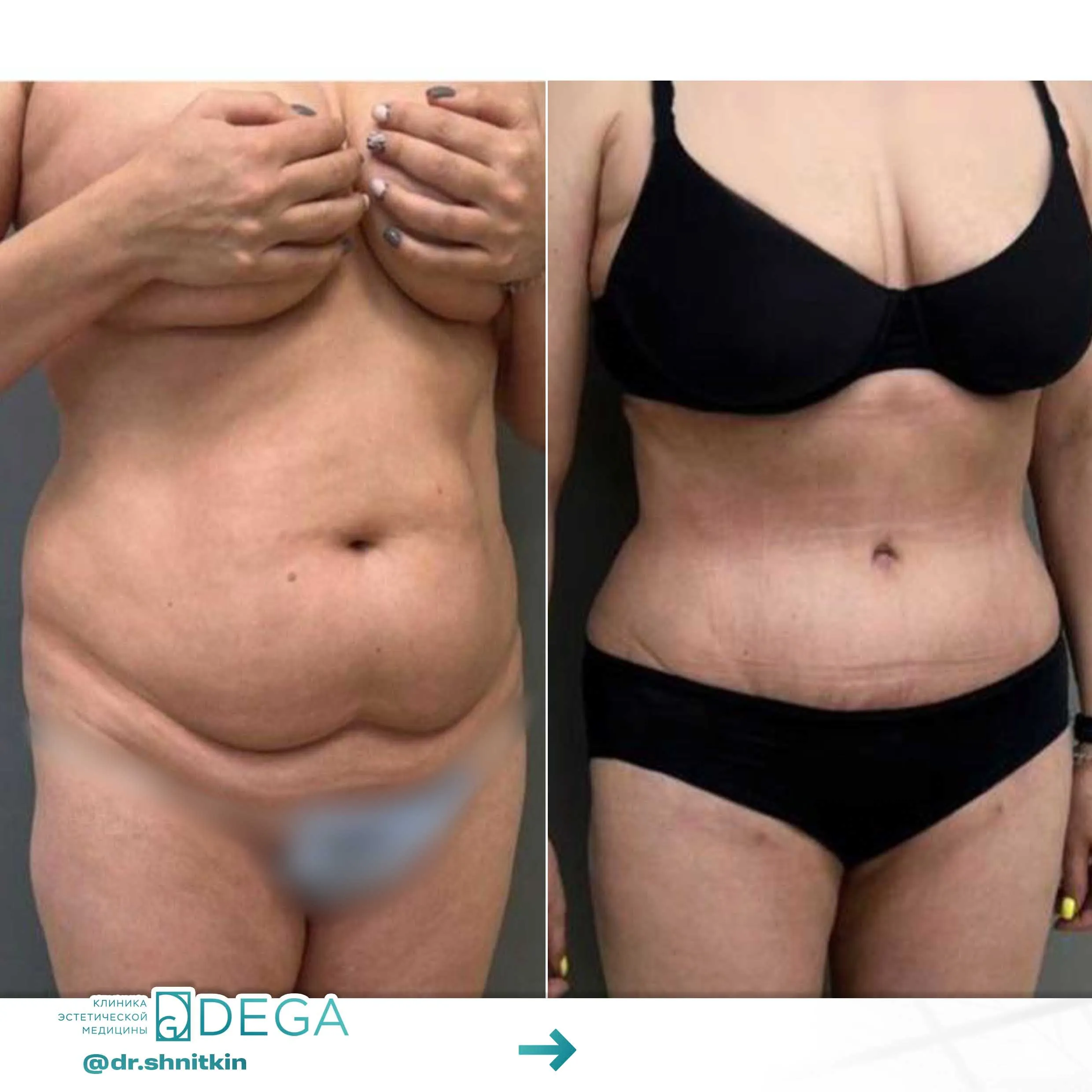 Шниткин Антон Сергеевич №21 Абдоминопластика (пластика живота) Пластика тела Липосакция живота