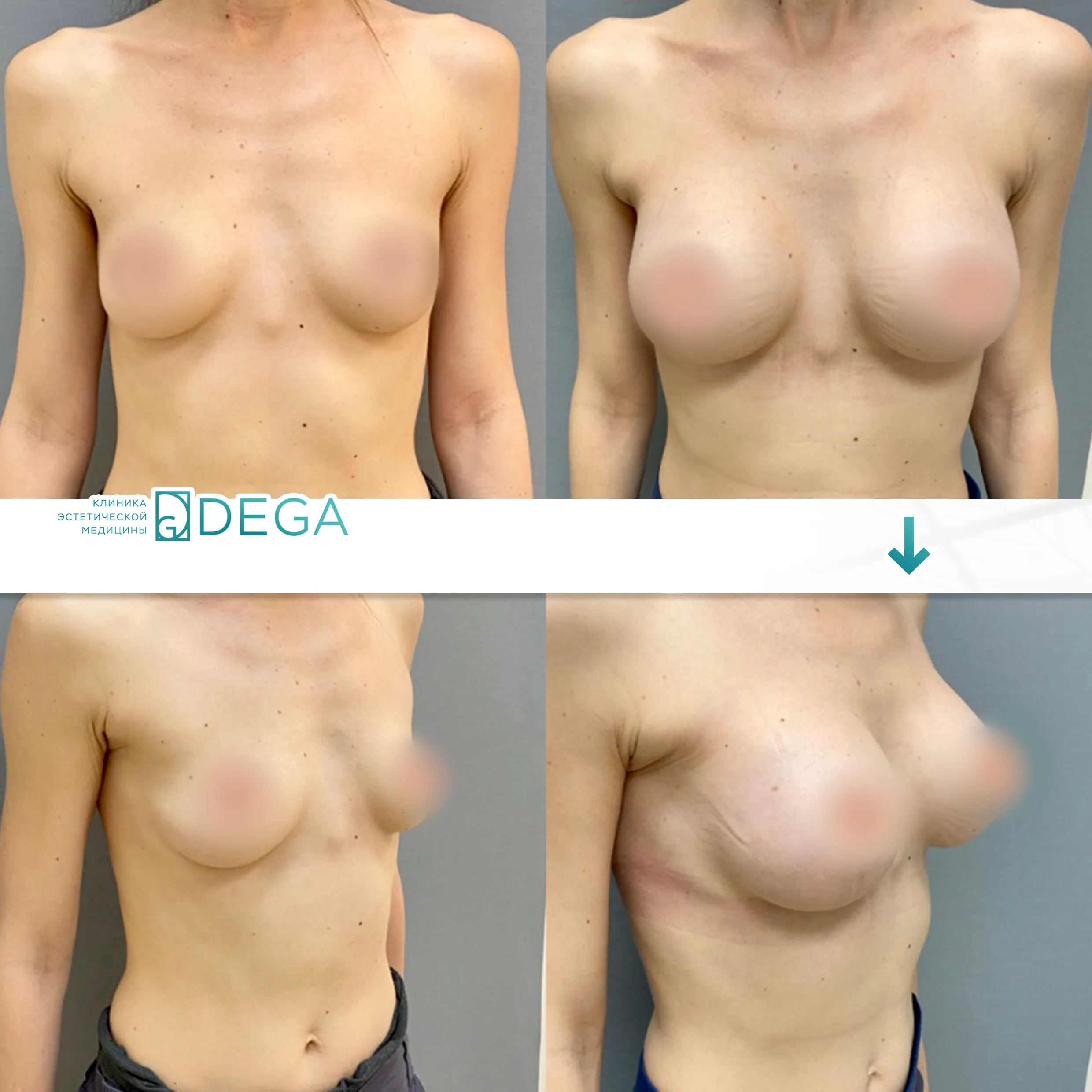 Шорников Евгений Сергеевич №11 Маммопластика Увеличение груди