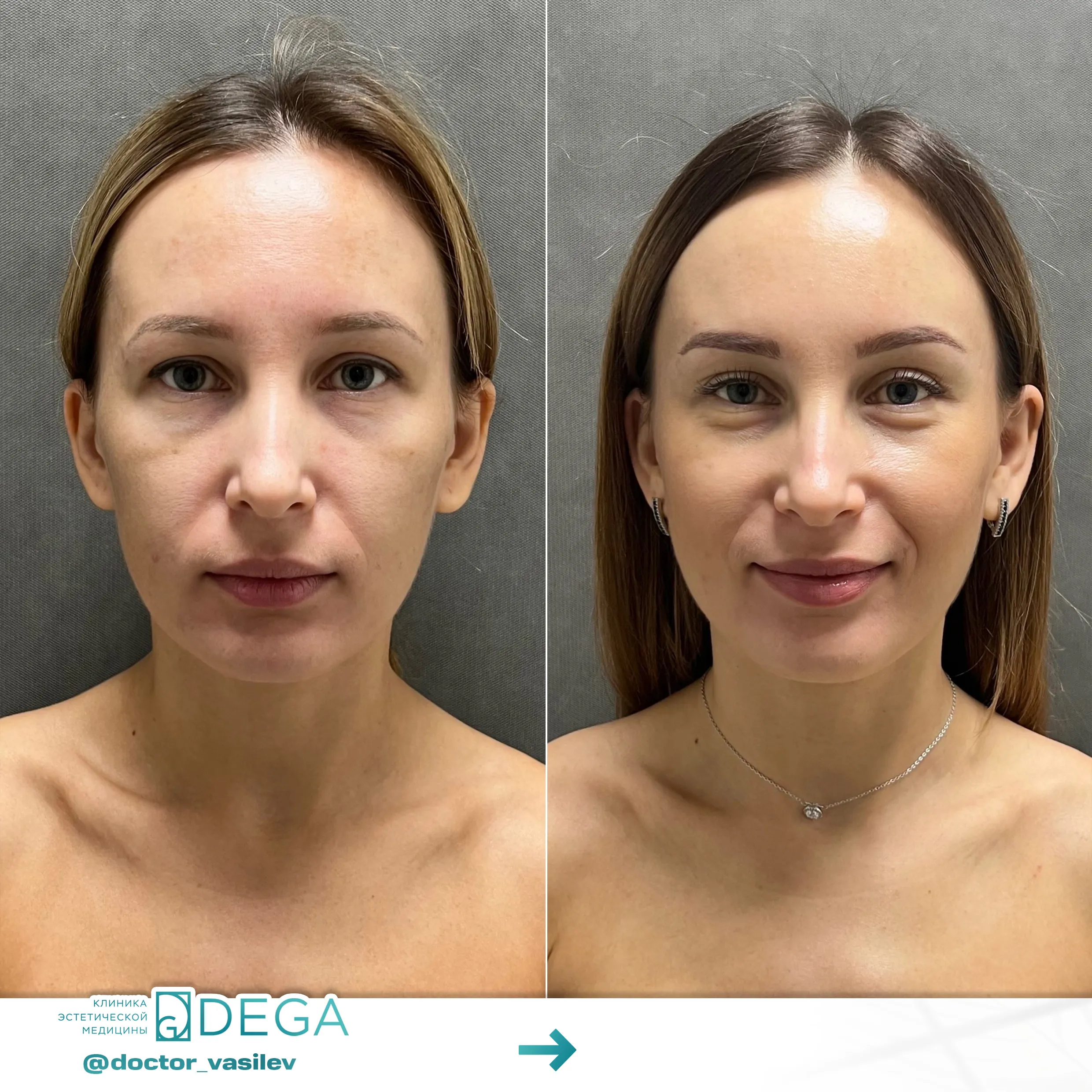 Васильев Д.О. - Эндоскопическая подтяжка лица №3