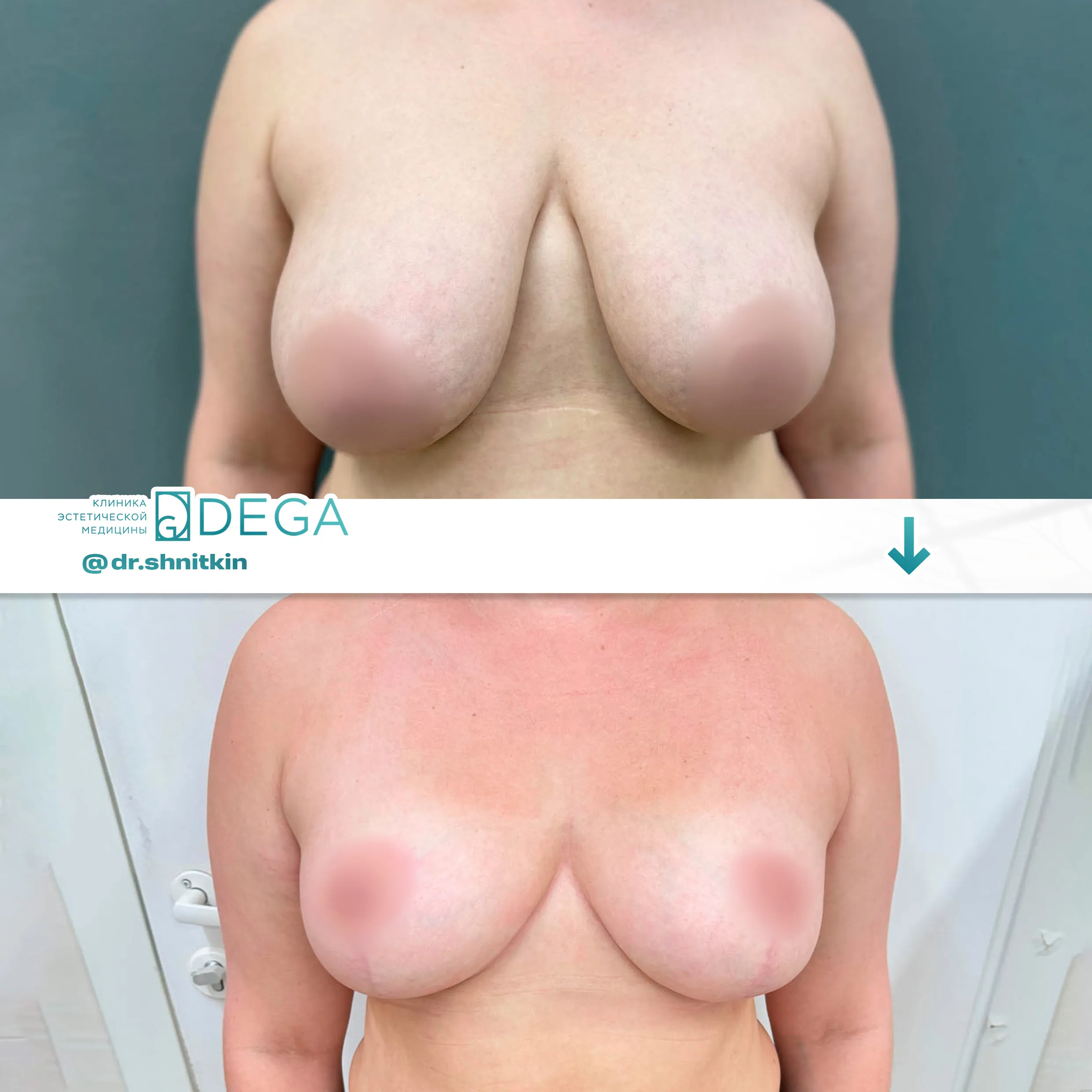 Шниткин Антон Сергеевич - Мастопексия (подтяжка груди) №26