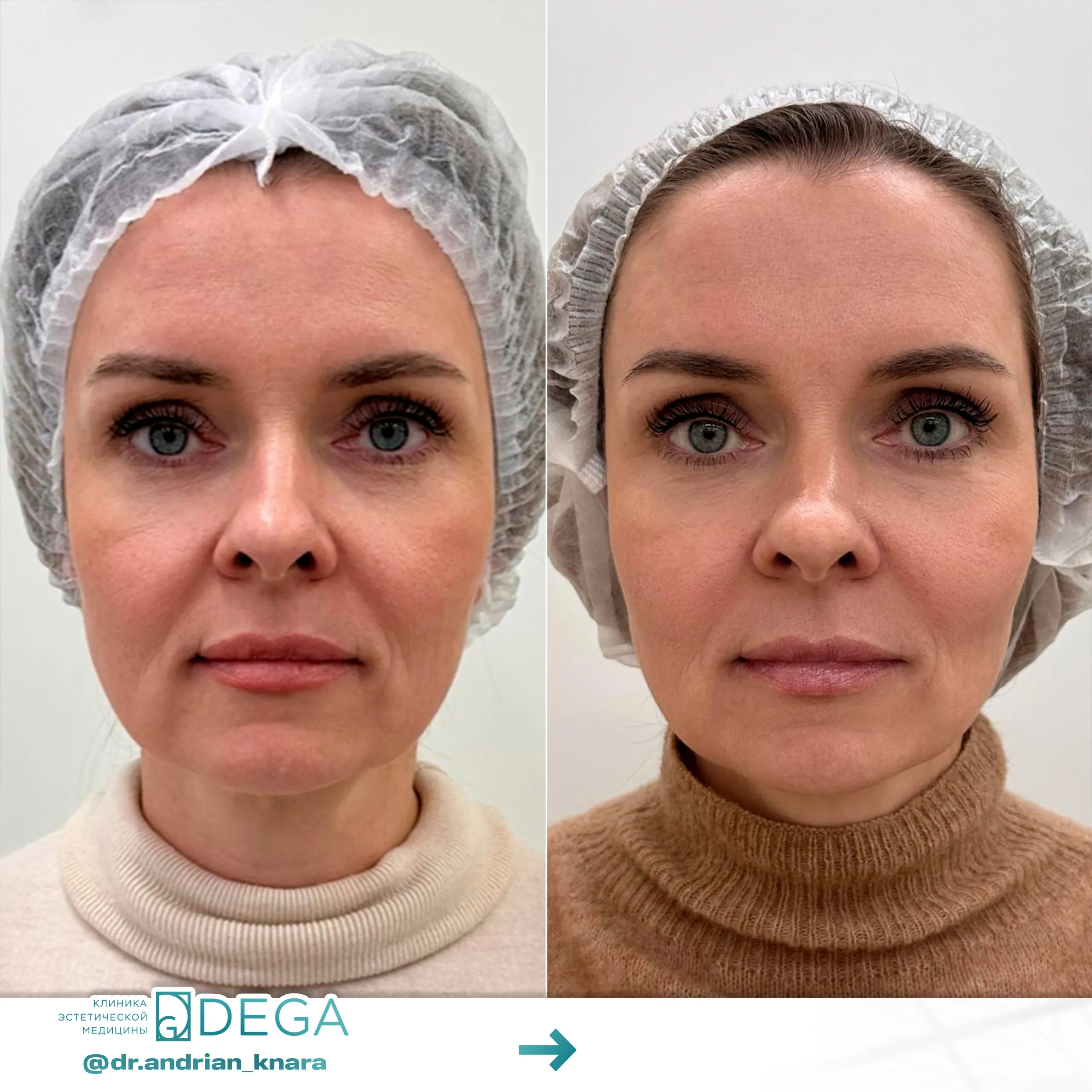 Андрян КВ - Монополярный RF-лифтинг Oligio №27