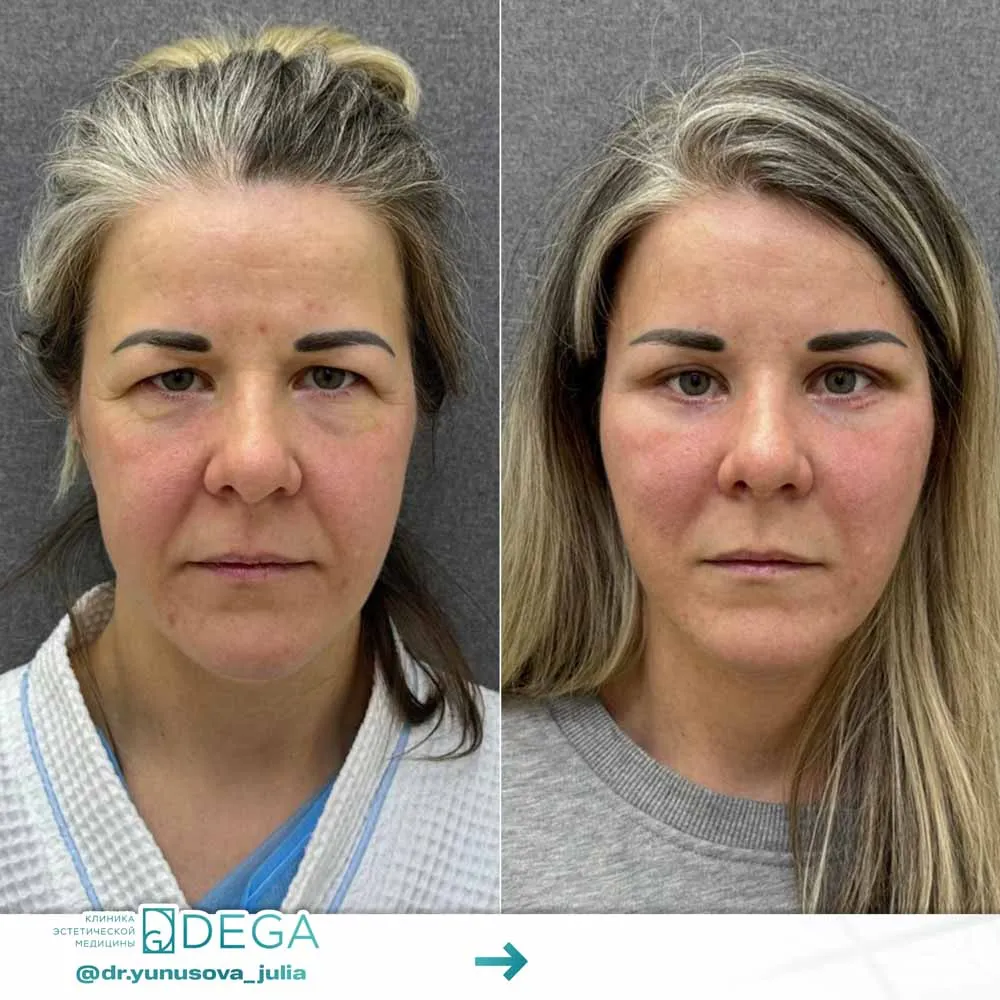 Юнусова ЮР - Эндоскопическая подтяжка лица, Блефаропластика №43