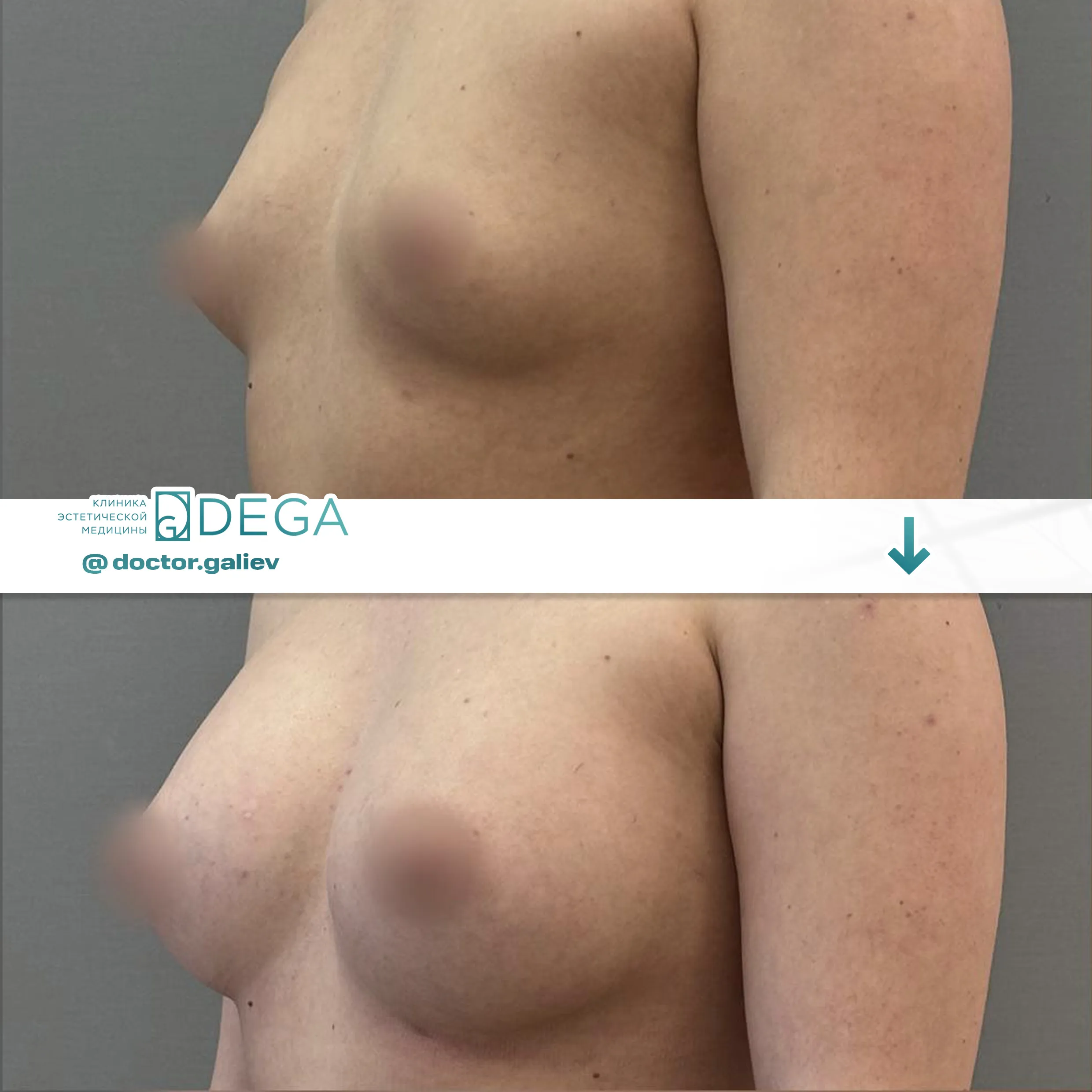 Галиев Ильмир Амирович №21Маммопластика Увеличение груди