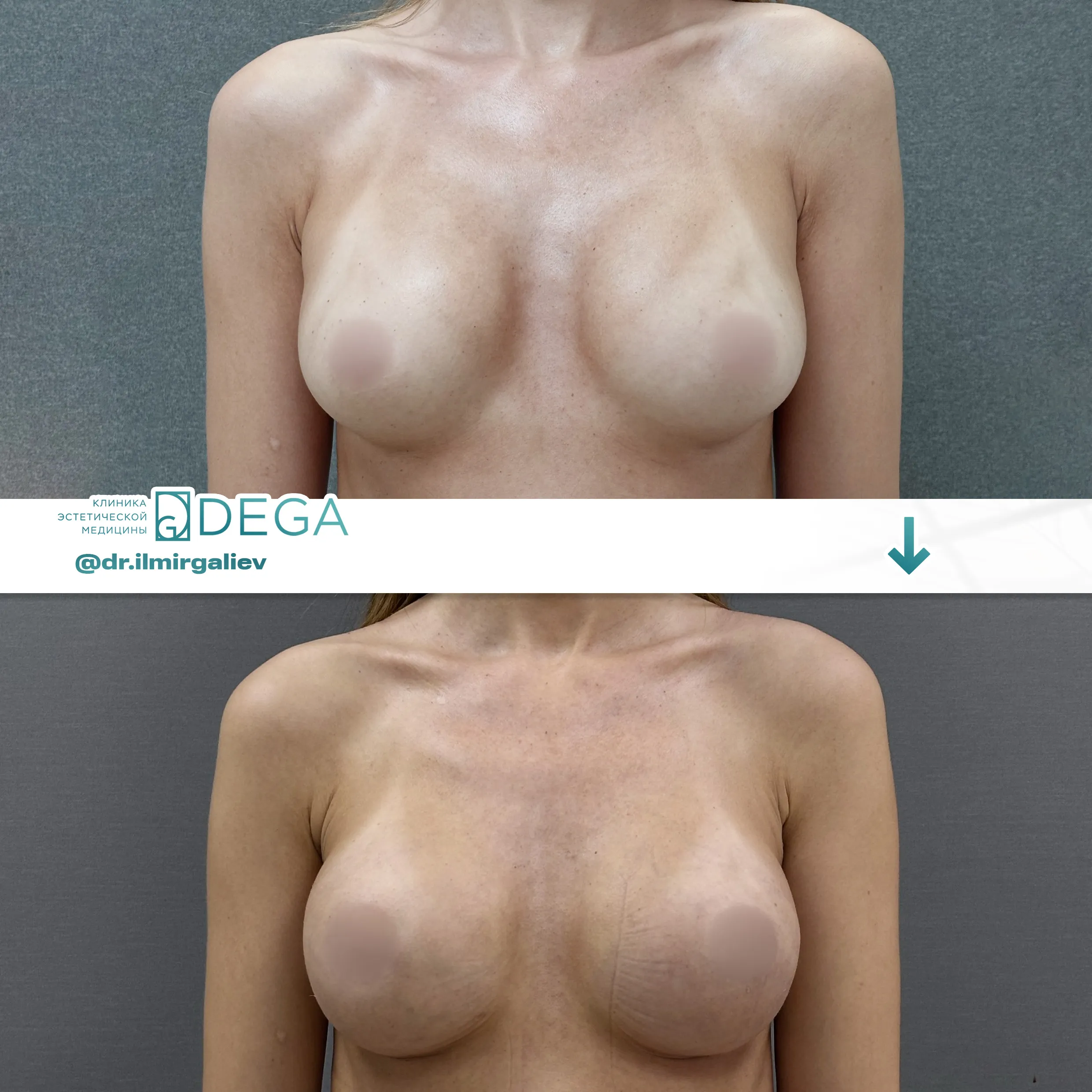 Галиев Ильмир Амирович №12 Маммопластика Увеличение груди