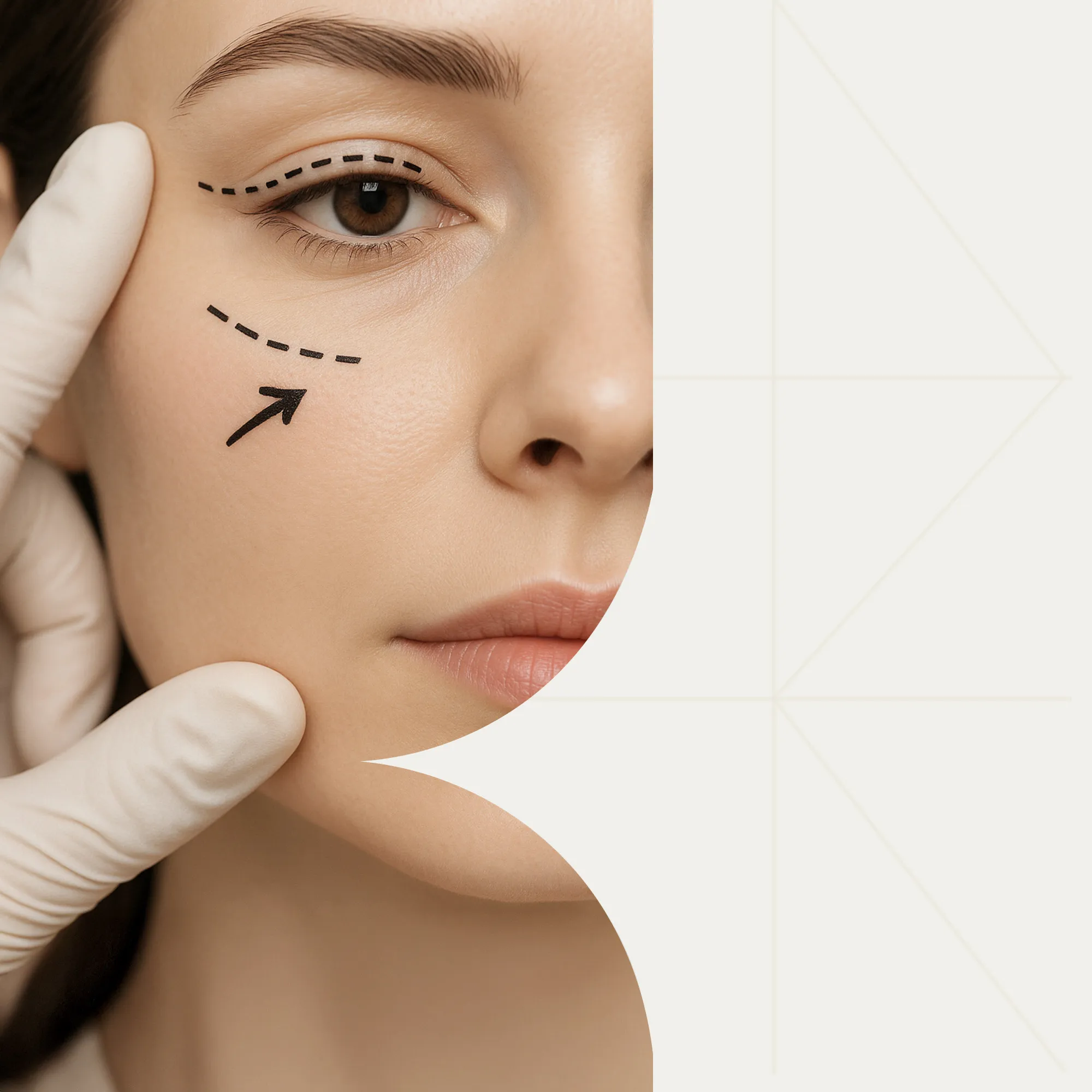 Швы после блефаропластики: что важно знать пациенту 