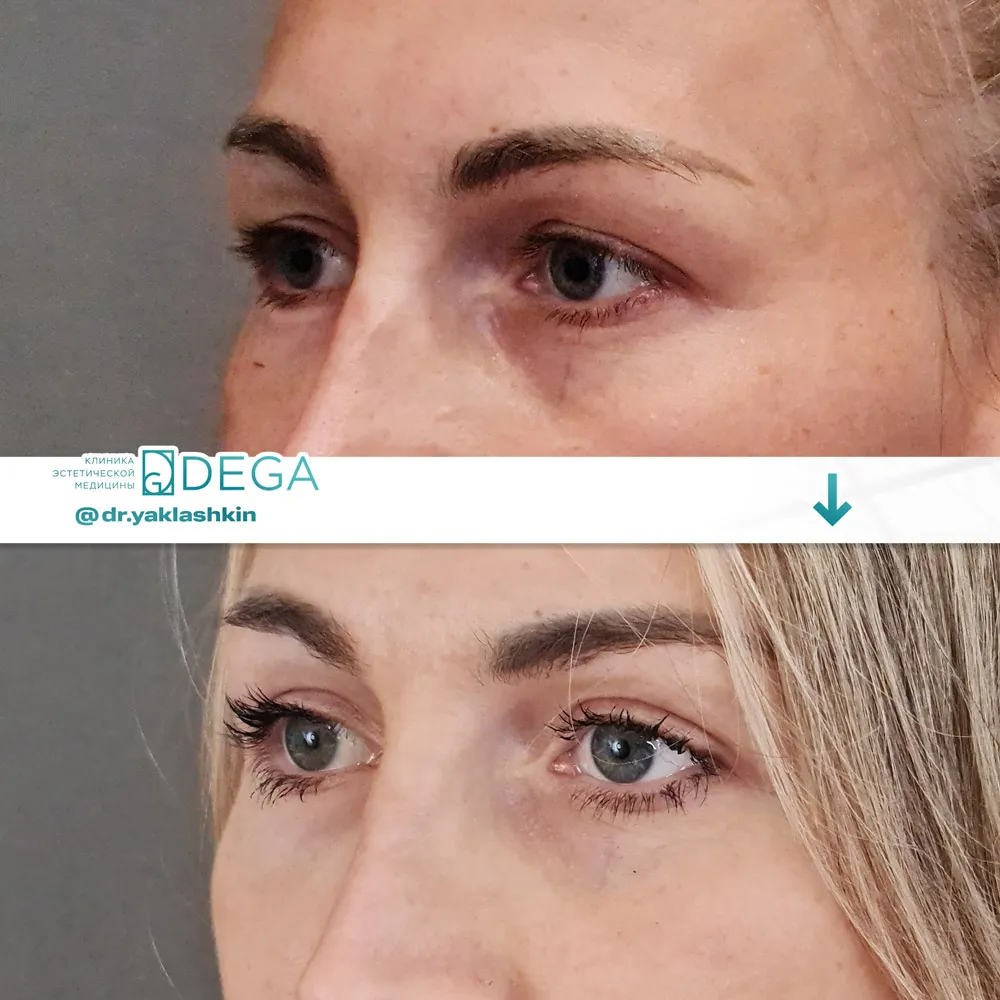 Яклашкин АВ - Блефаропластика №4