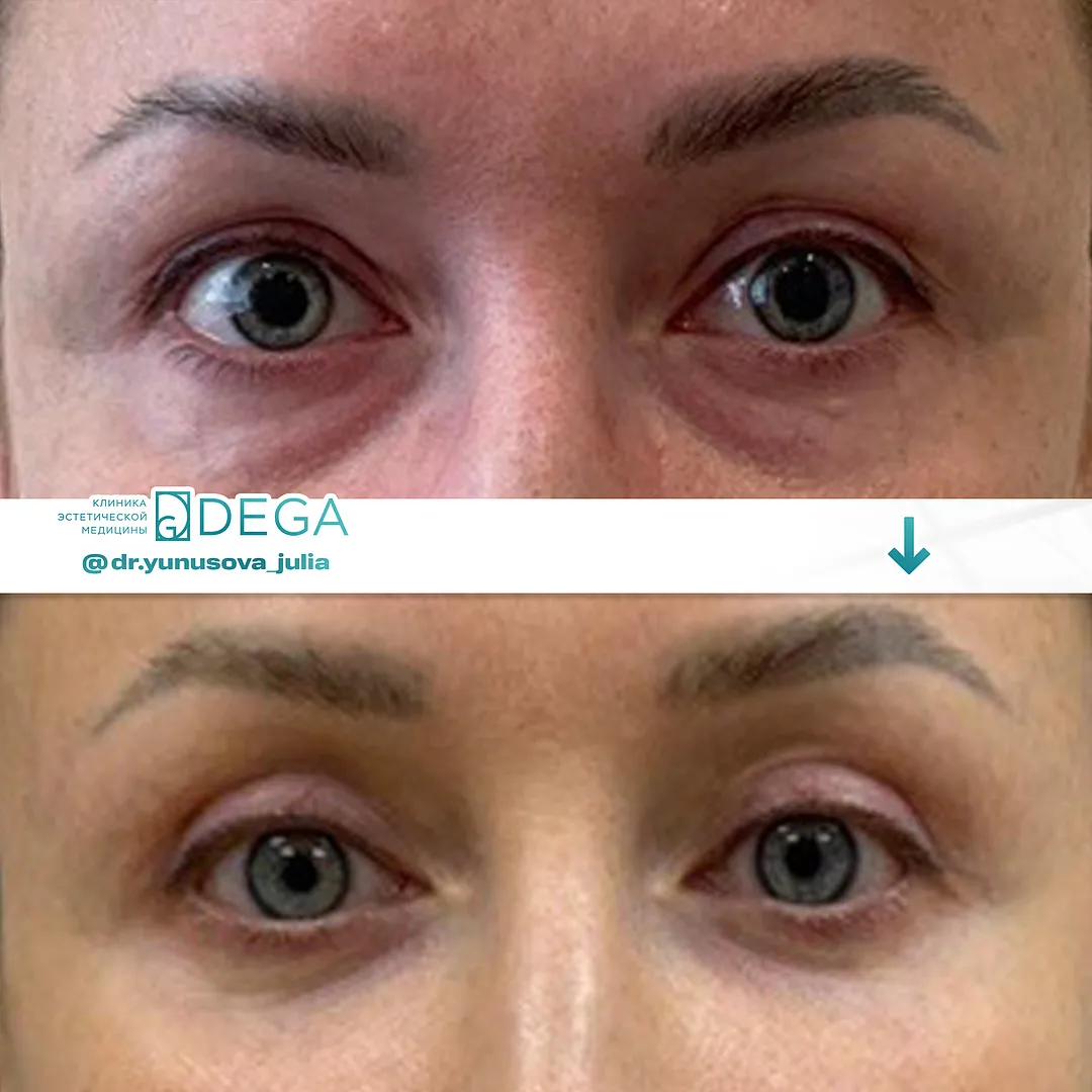 Юнусова ЮР - Блефаропластика №41