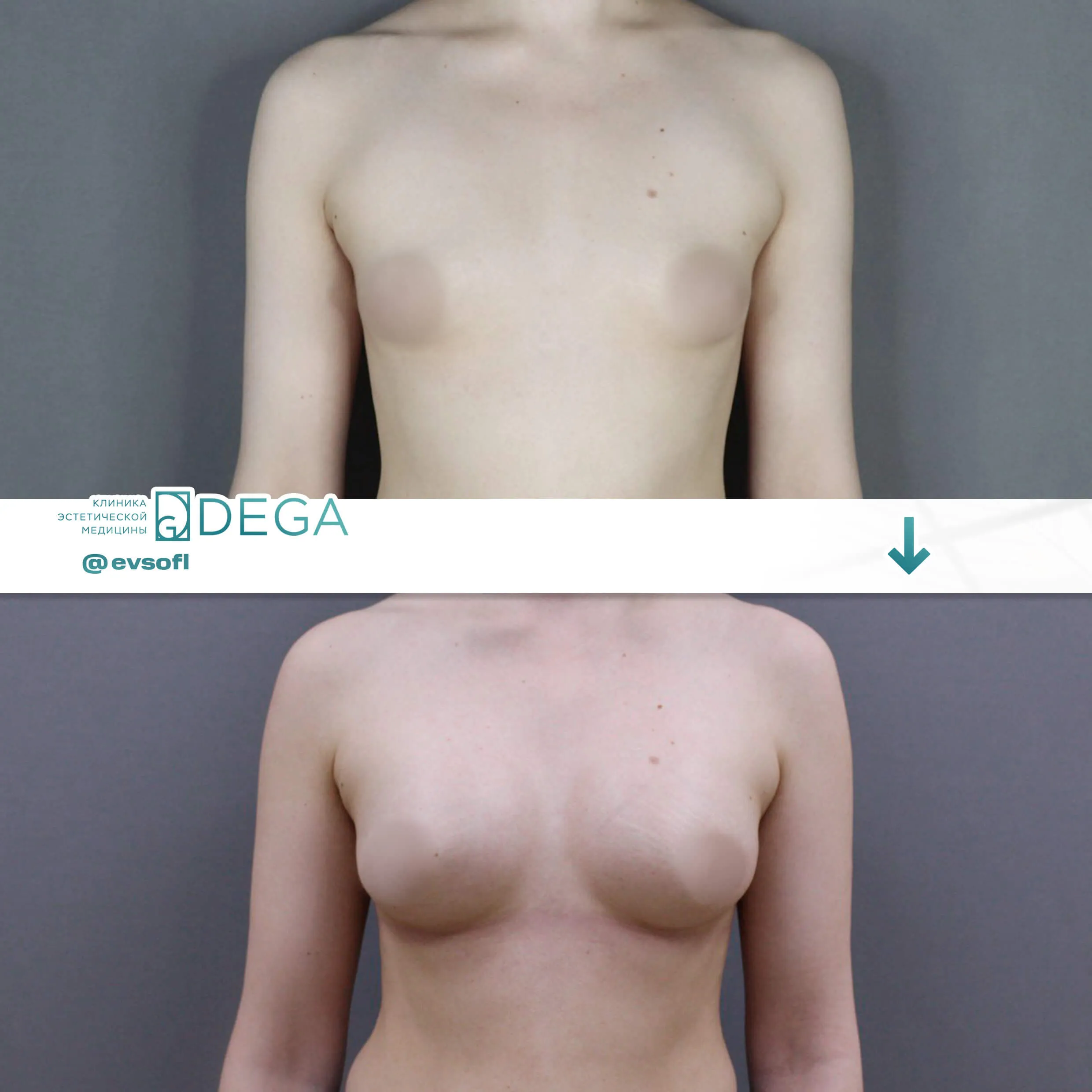 Шорников Евгений Сергеевич - Увеличение груди №18