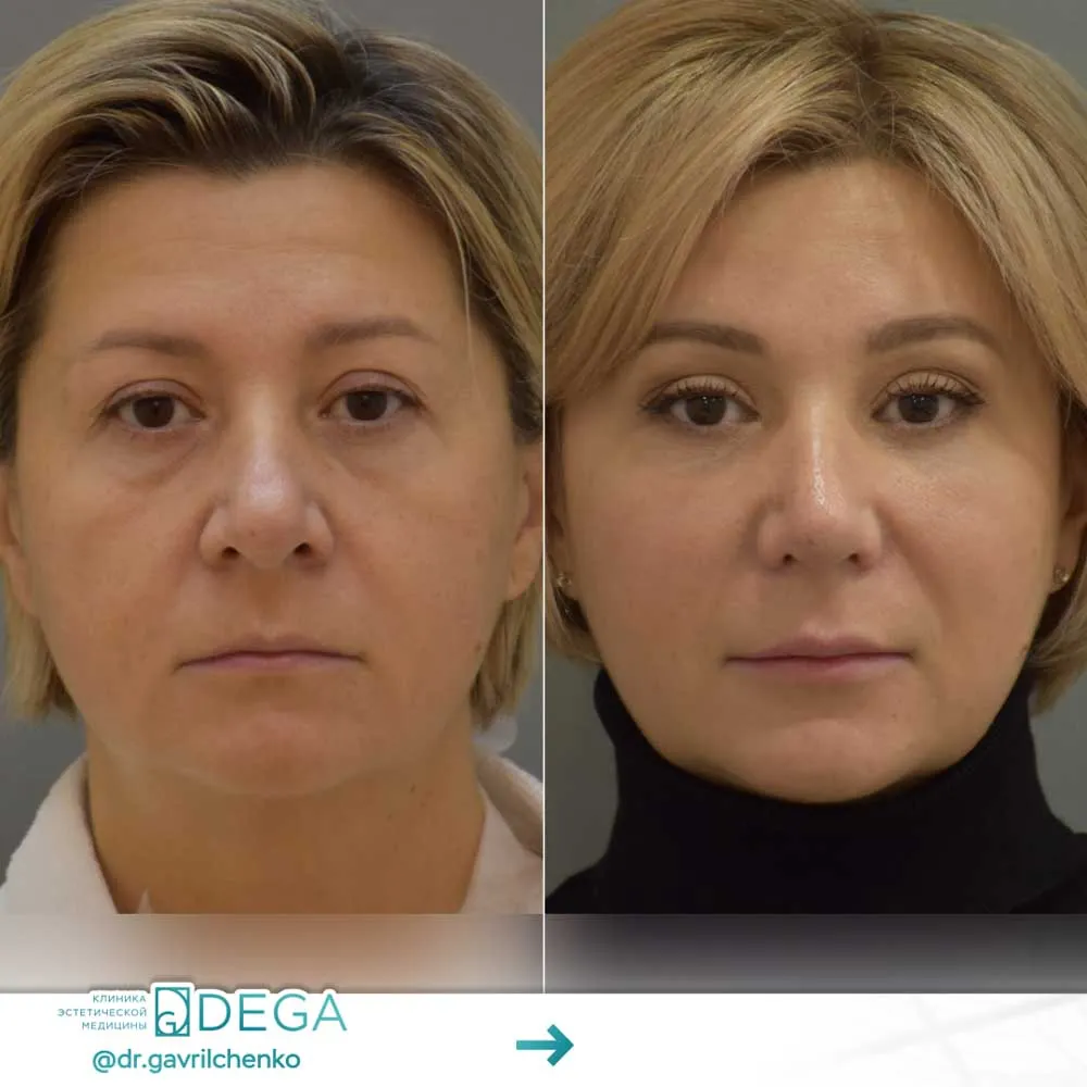 Гаврильченко АА - Эндоскопическая периорбитопластика, Ринопластика, Блефаропластика №4