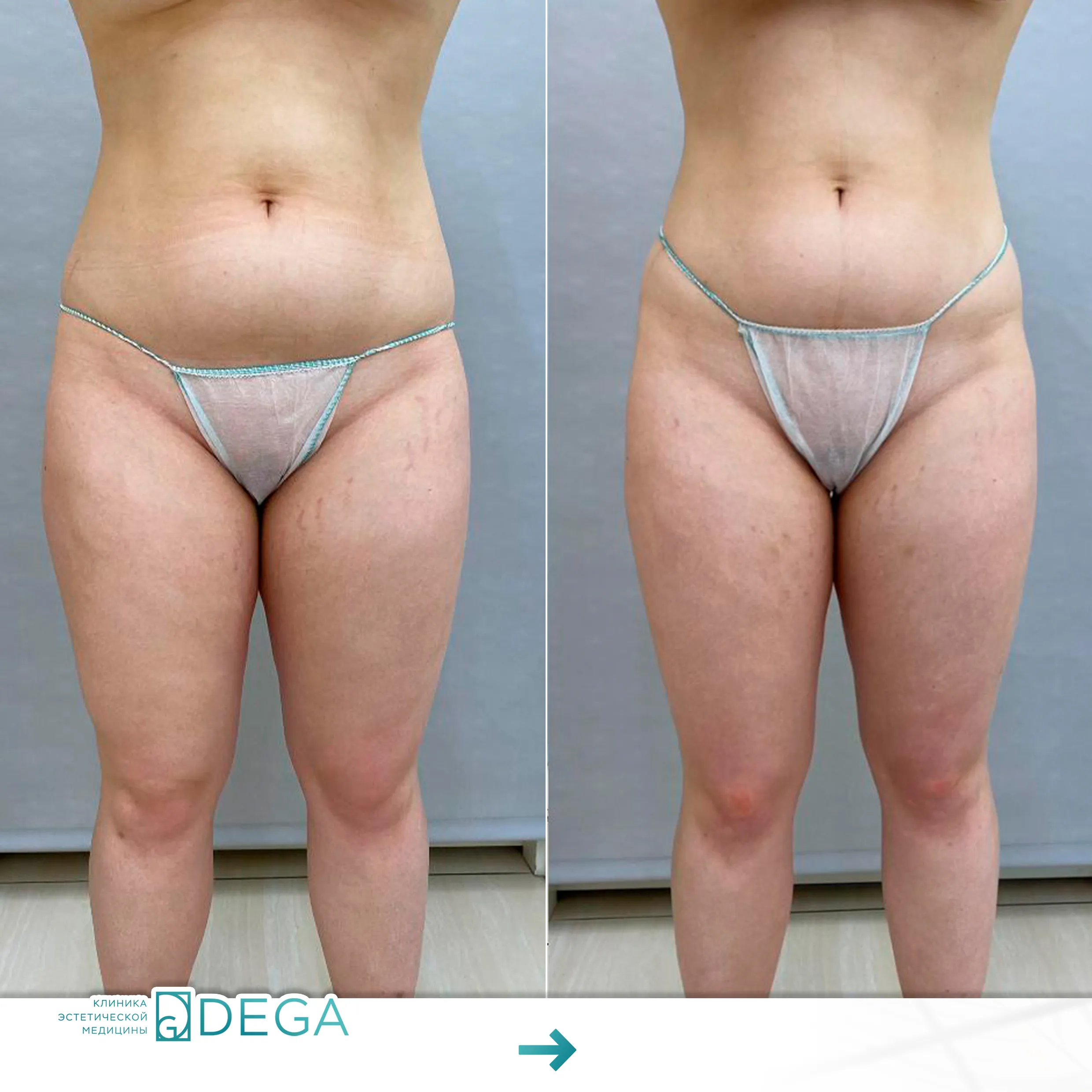 Горновая О.A. - Лазерный липолиз №2