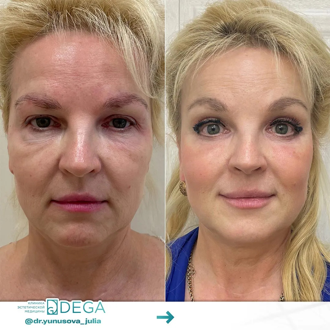 Юнусова ЮР - Блефаропластика №10