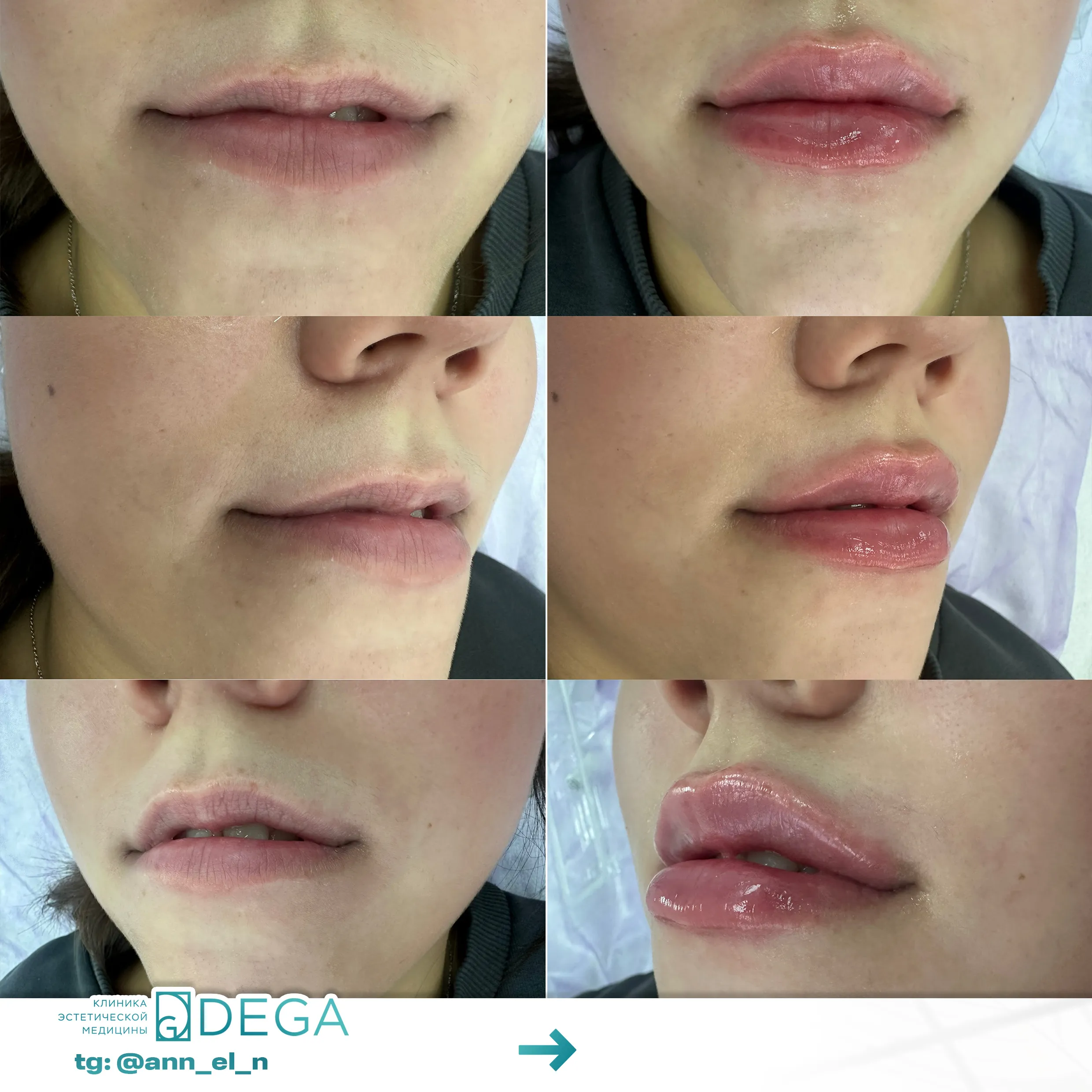 Дулмаева А.О. - Контурная пластика губ №3