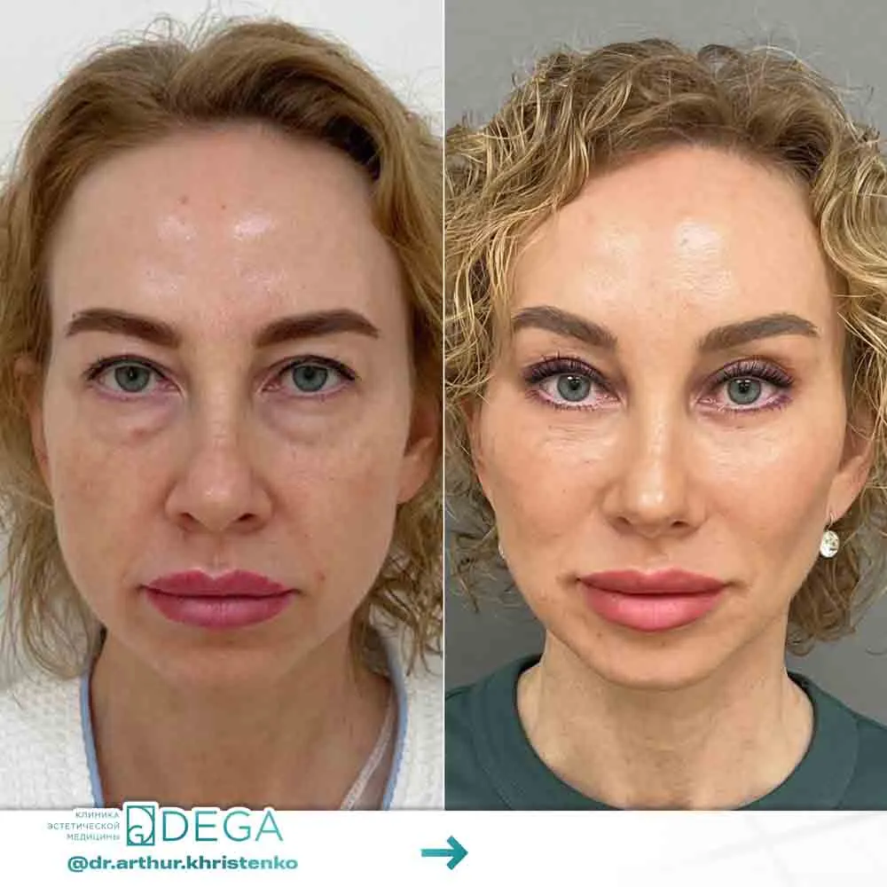 Христенко АА - Эндоскопическая периорбитопластика №5