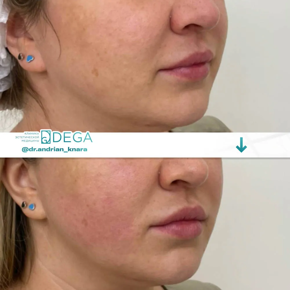 Андрян КВ - SMAS-лифтинг №1