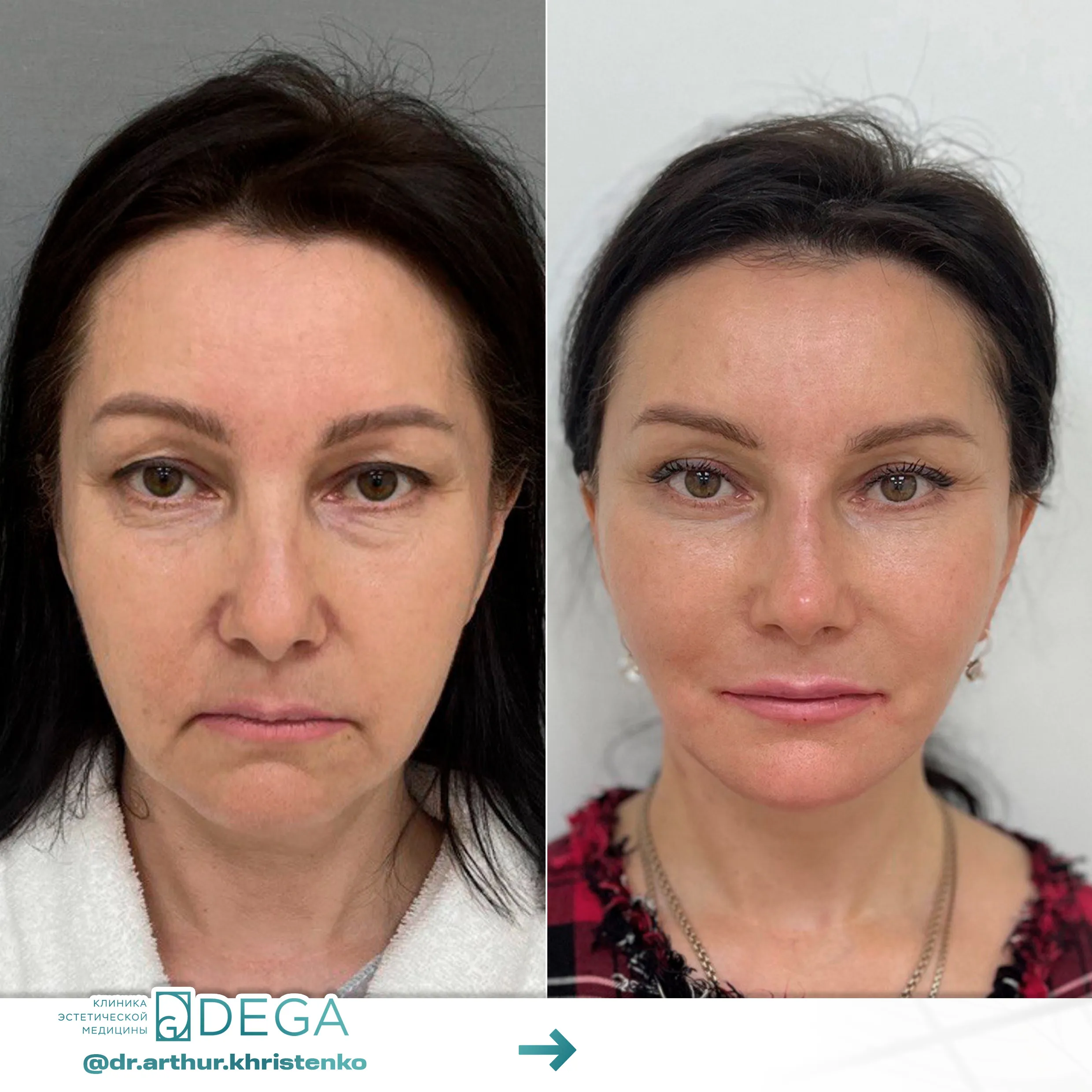 Христенко АА - ESP-Lifting, Эндоскопическая подтяжка, Фейслифтинг, Платизмопластика №13