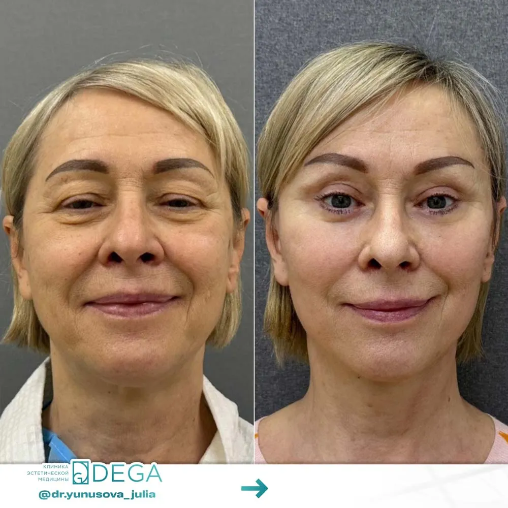 Юнусова ЮР - Периорбитопластика, Блефаропластика №44