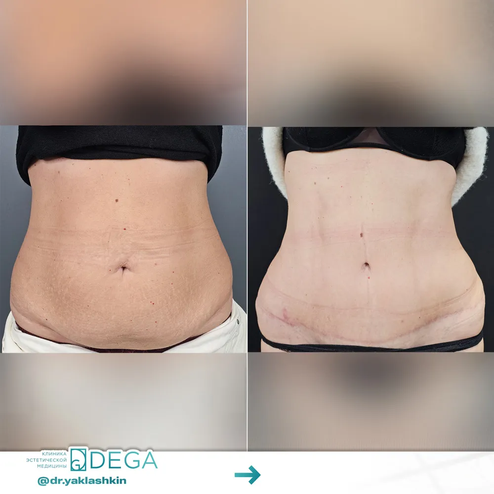 Яклашкин АВ - Абдоминопластика №2