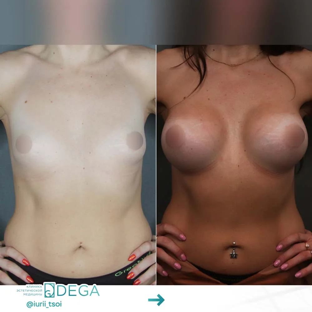 Цой ЮР - Увеличение груди №5