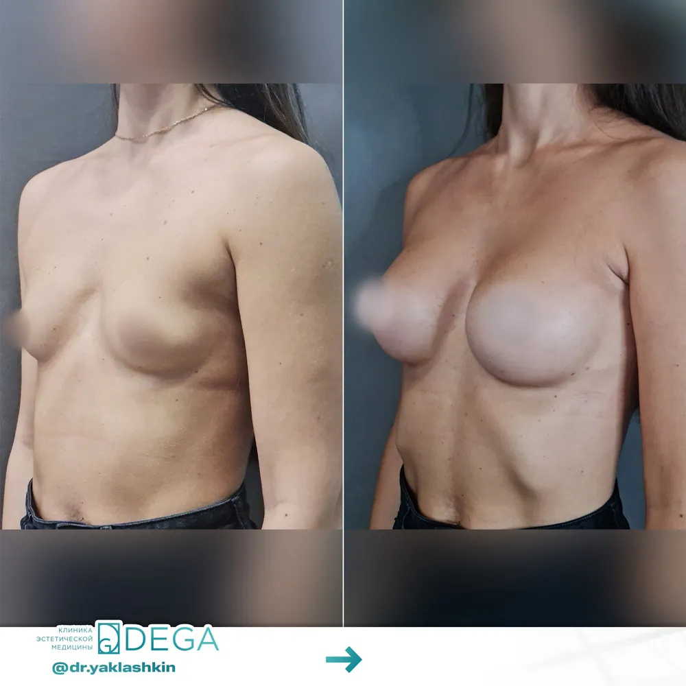 Яклашкин АВ -  Увеличение груди №9
