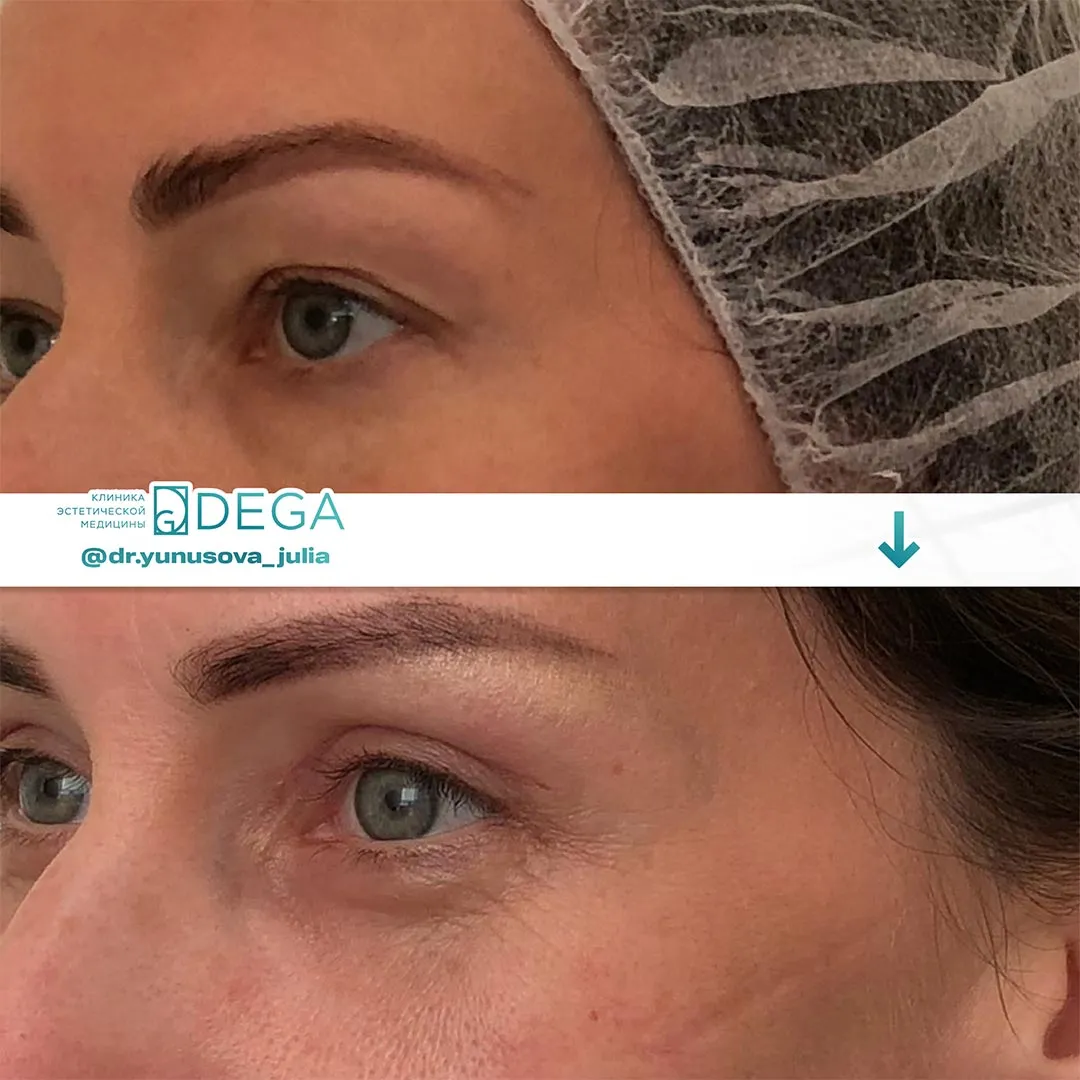 Юнусова ЮР - Блефаропластика №11
