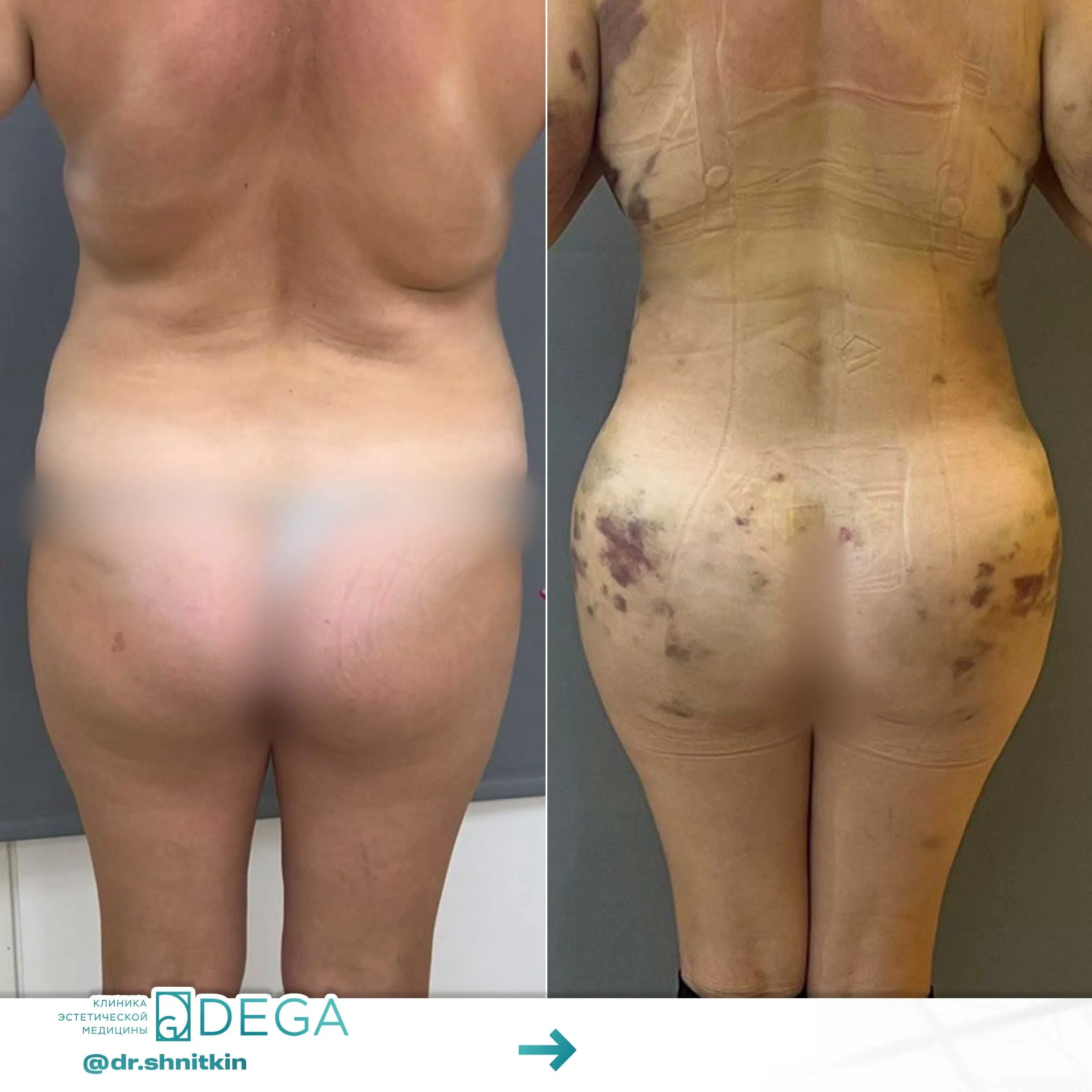 Шниткин Антон Сергеевич №10 Липосакция бедер Липосакция живота Пластика тела Липофилинг бедер Липофилинг тела Липофилинг ягодиц