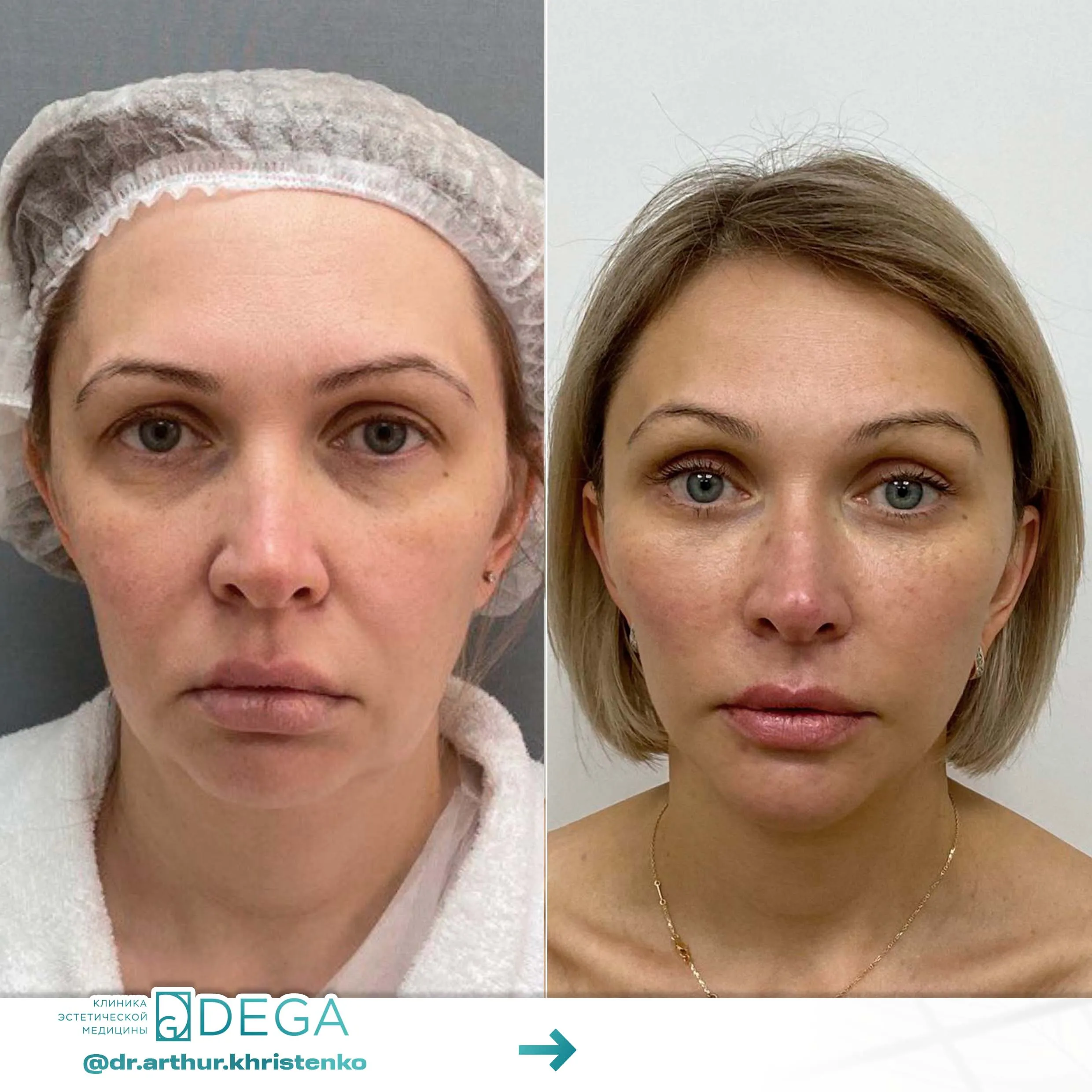 Христенко АА - ESP-Lifting, Эндоскопическая подтяжка, Фейслифтинг, Платизмопластика №19