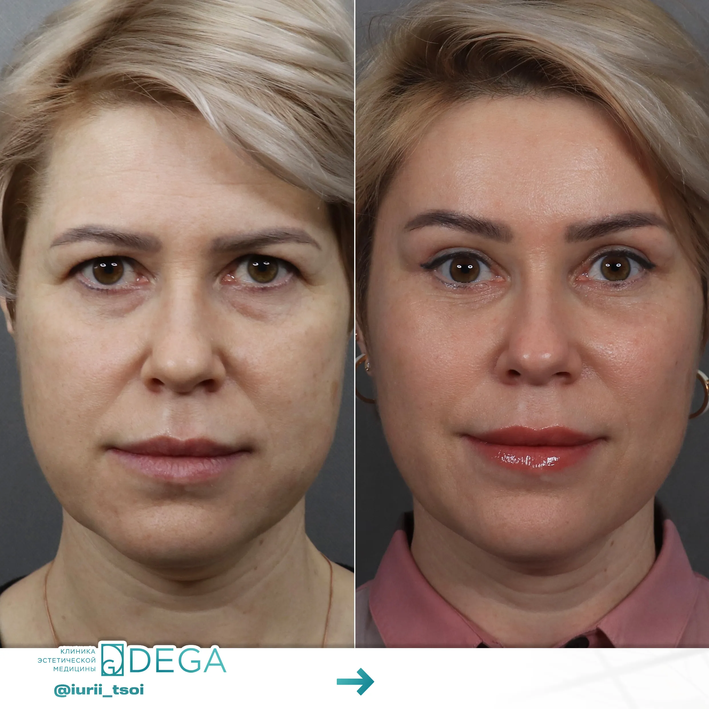 Цой ЮР - Эндоскопическая периорбитопластика №9