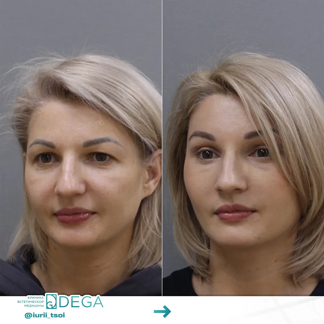 Цой ЮР - Блефаропластика, Эндоскопическая подтяжка №25