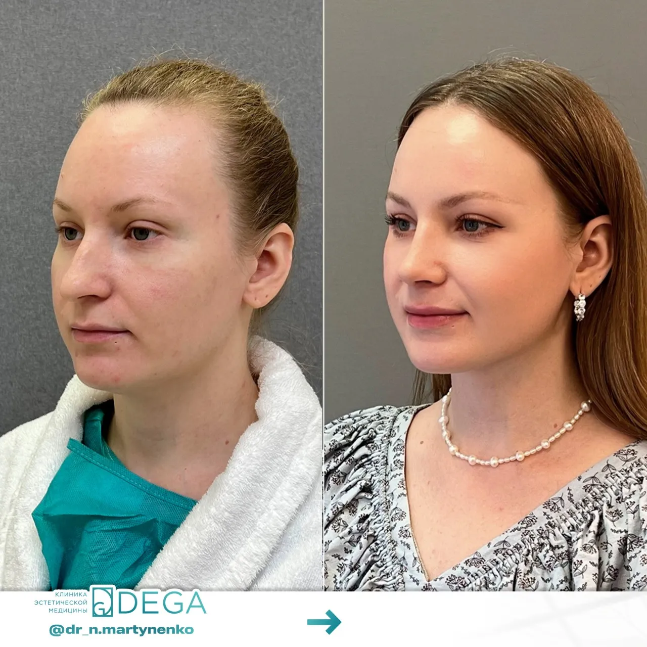 Мартыненко Н. А. — Ринопластика  №17