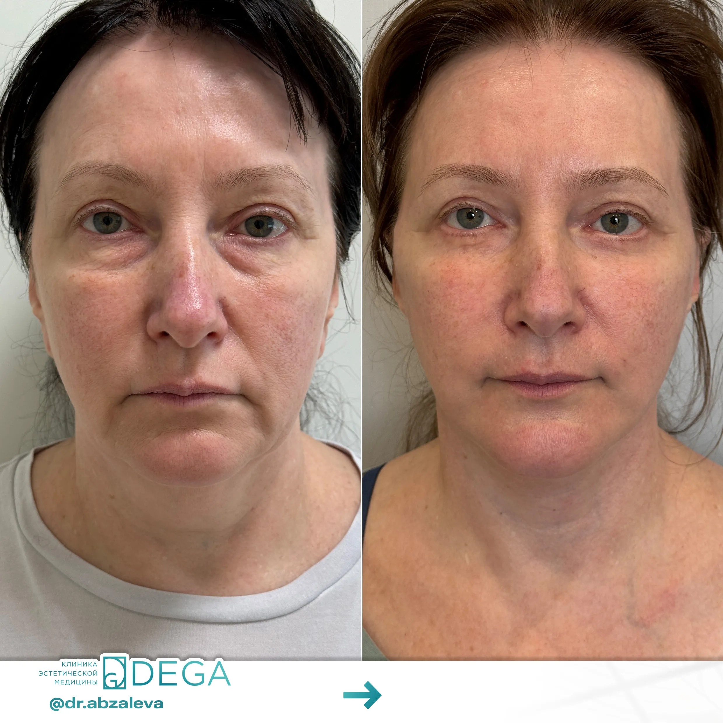 Абзалева Г.Р. - Фейслифтинг, Платизмопластика, Блефаропластика №2