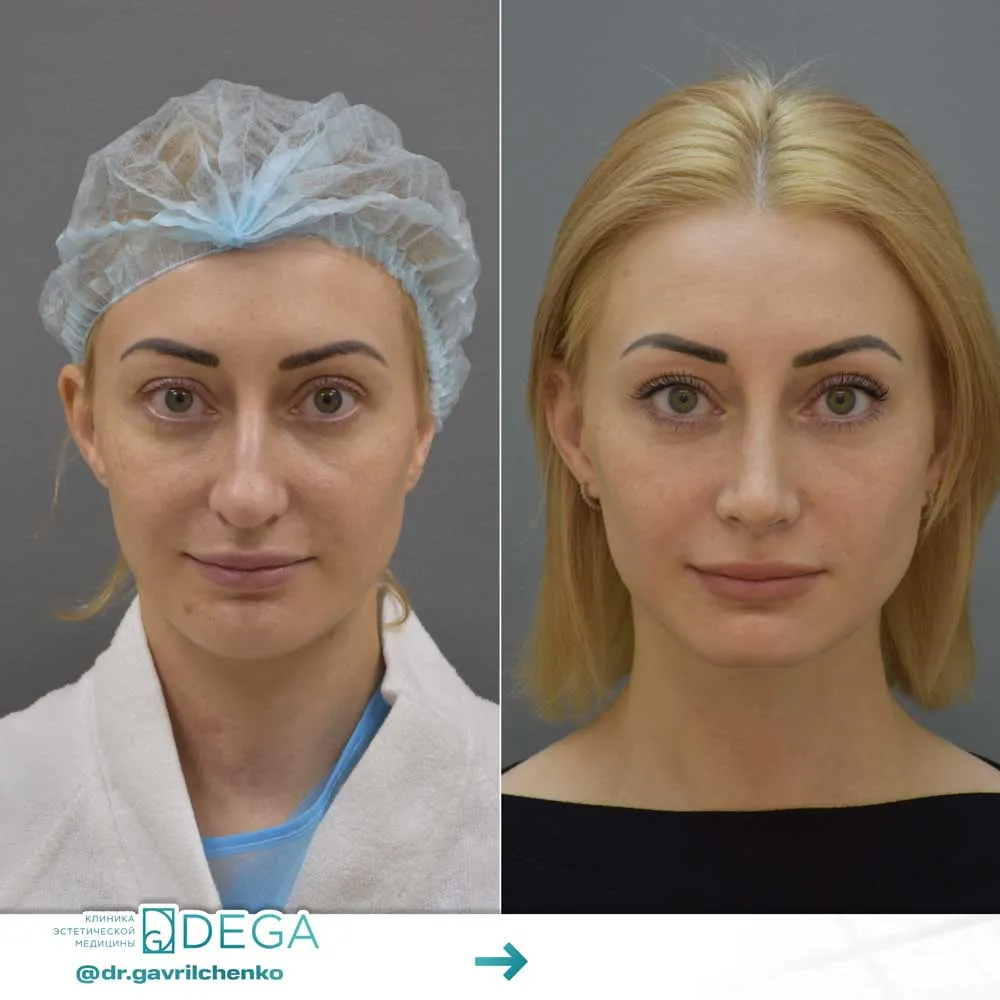Гаврильченко АА - Ринопластика №49