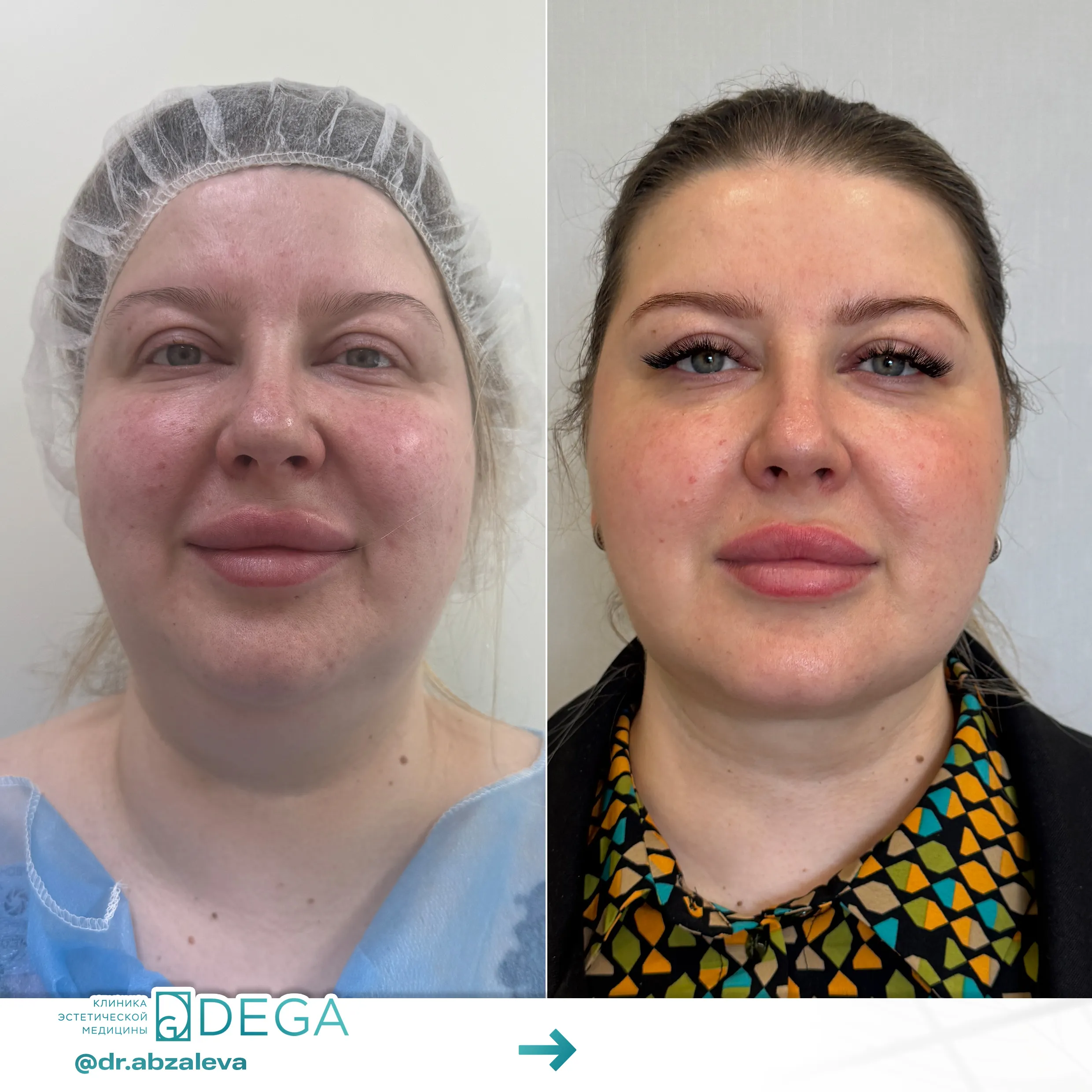 Абзалева Г.Р. - Липосакция лица №5