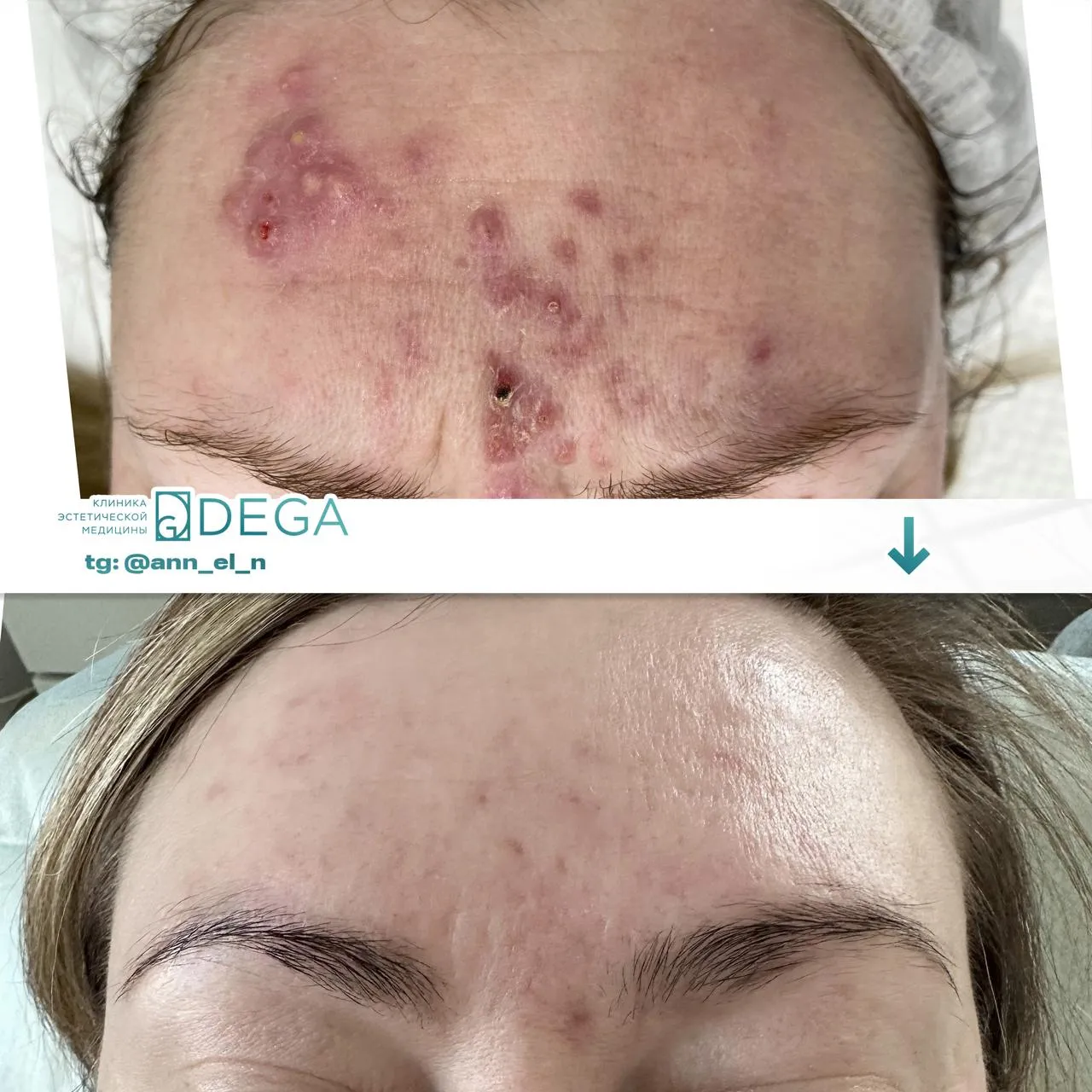 Дулмаева А.О. - Фотодинамическая терапия Heleo4 №6