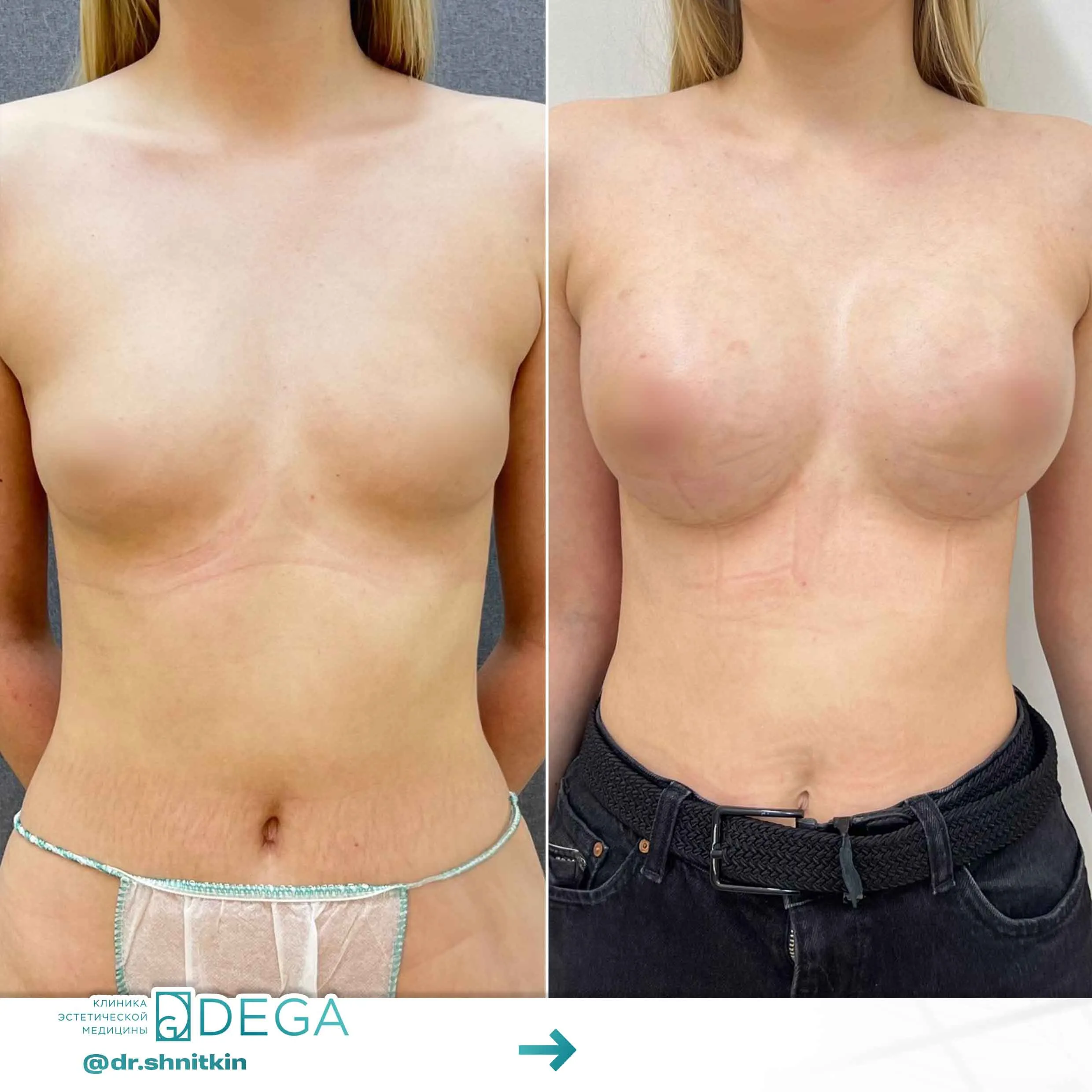 Шниткин Антон Сергеевич №24 Маммопластика