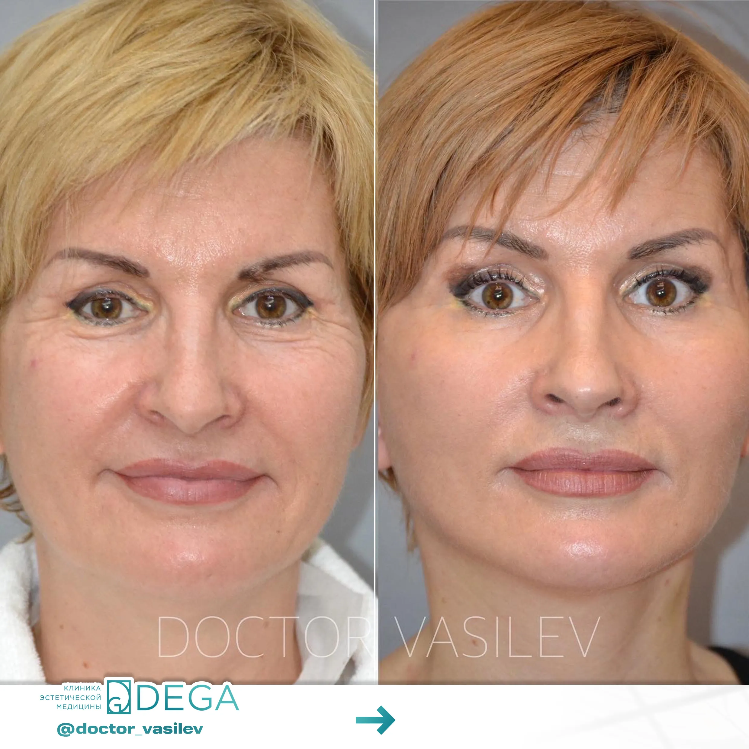 Васильев Д.О. - Блефаропластика №1