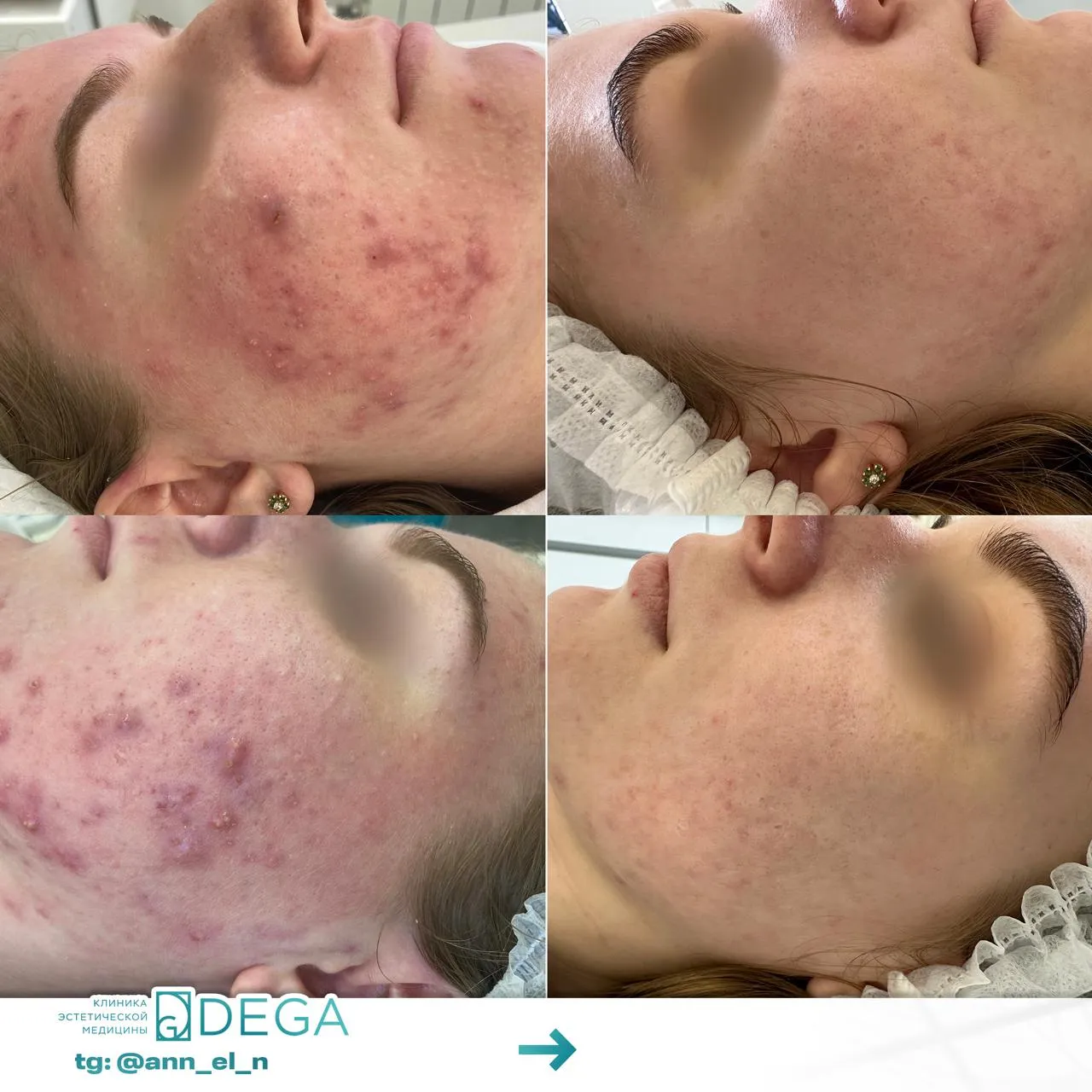 Дулмаева А.О. - Лечение Акне №10